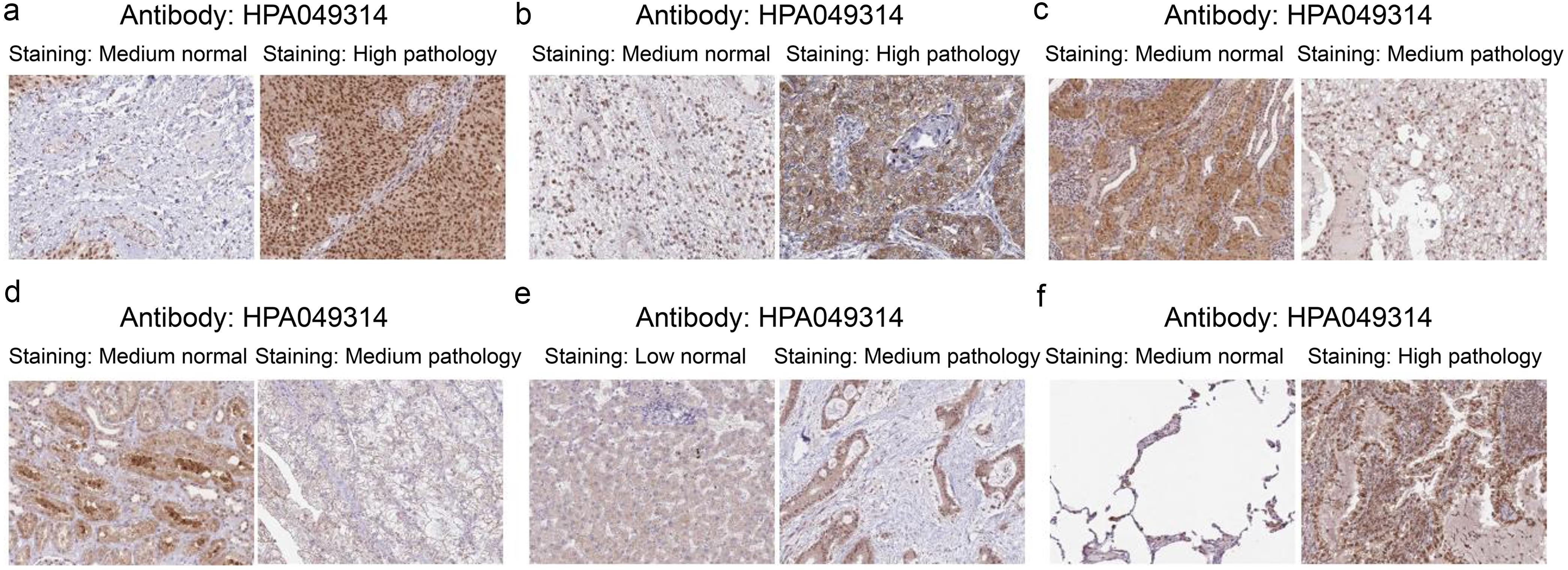 Representative Human Protein Atlas immunohistochemistry images of TMED3 in normal and tumor tissues.