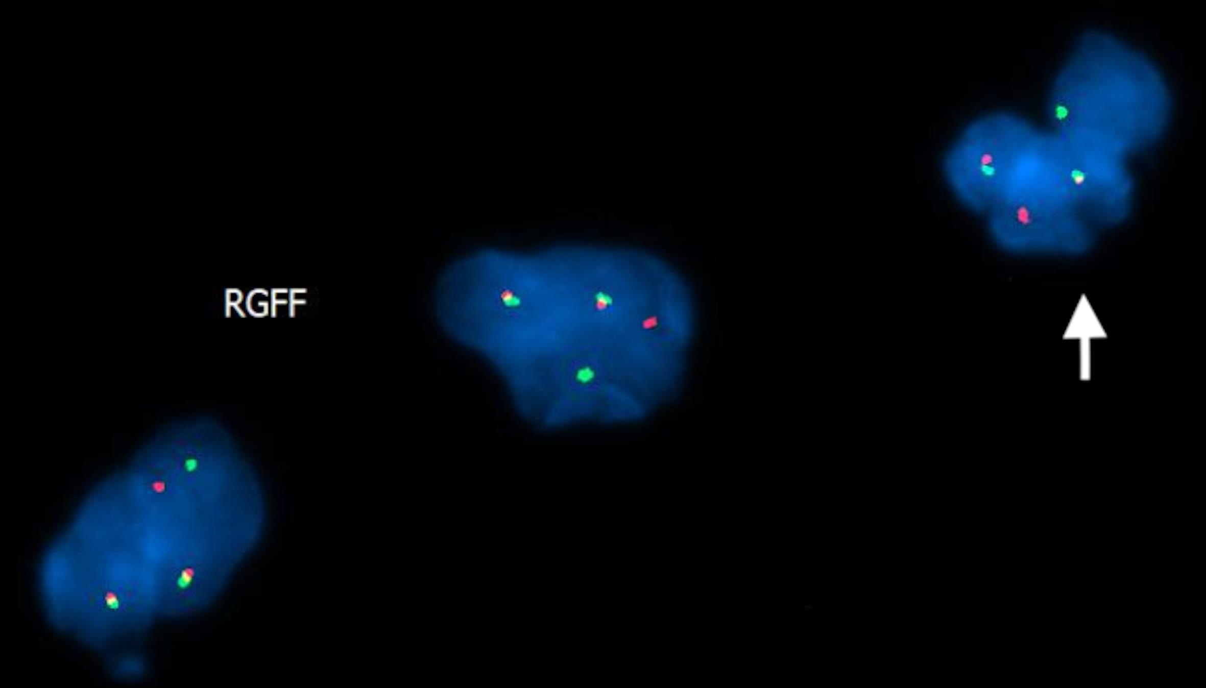 A FISH image showing several cells with <italic>BCR::ABL1</italic> fusion signals, including a possible segmented neutrophil (arrow).