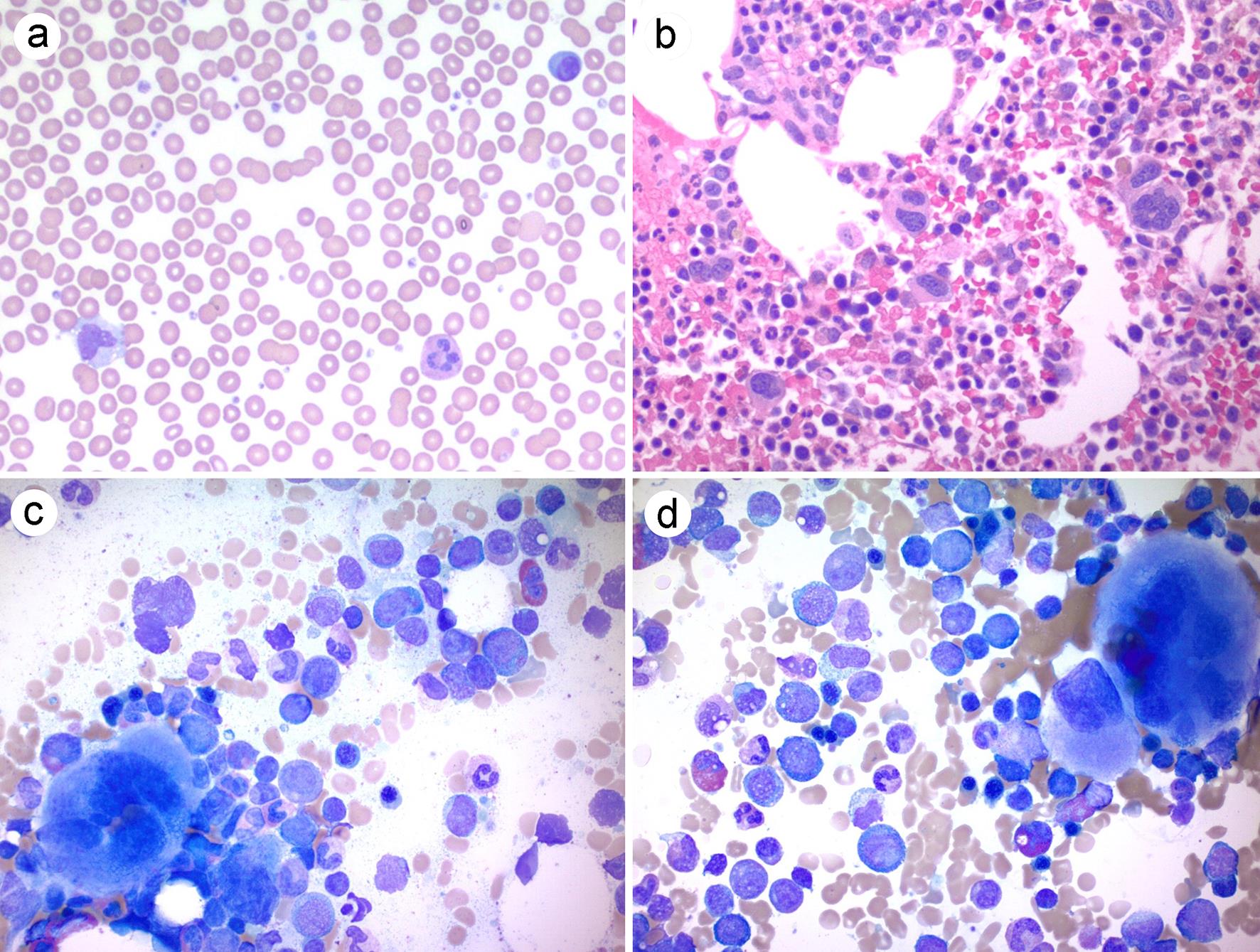 Peripheral blood and bone marrow morphology at 16 months post-diagnosis.