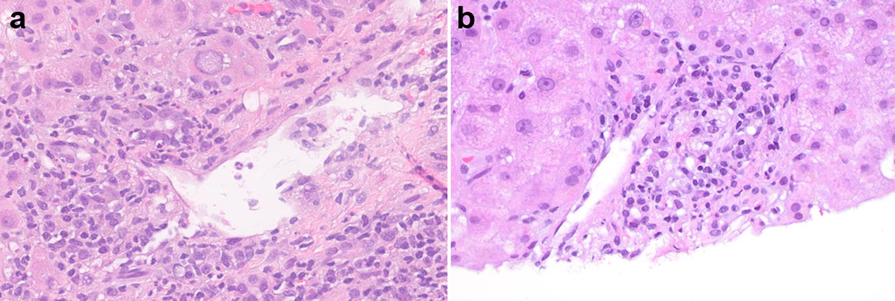 Immune checkpoint inhibitor-induced liver injury, cholangitic pattern.