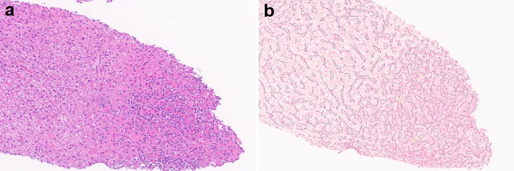 Immune checkpoint inhibitor-induced liver injury showing