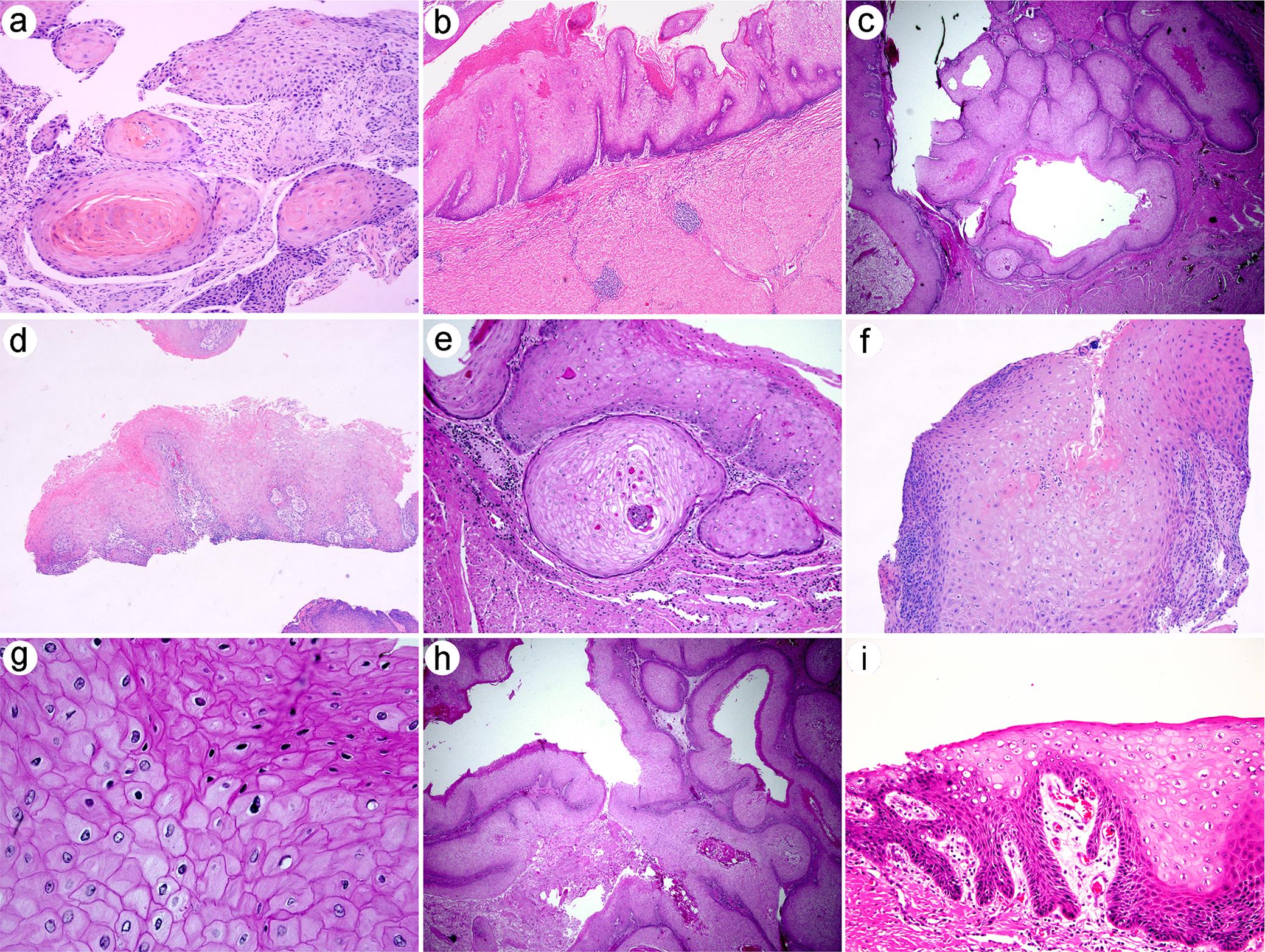 Well-differentiated squamous cell carcinoma of the esophagus.