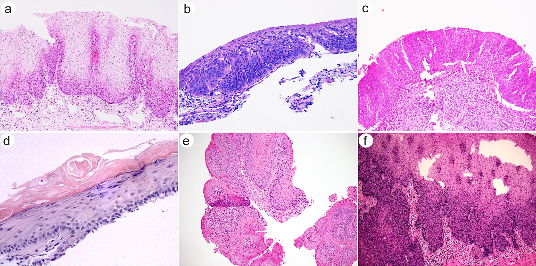 Precursor lesions and mimics of esophageal well-differentiated squamous cell carcinoma.
