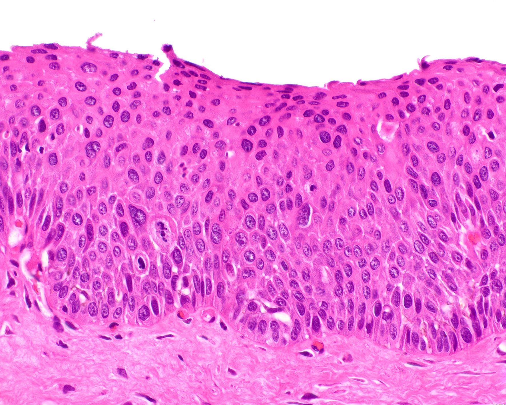 Anal biopsy without pigment and with HSIL (high-grade squamous intraepithelial lesion, H&E, original magnification 40×).