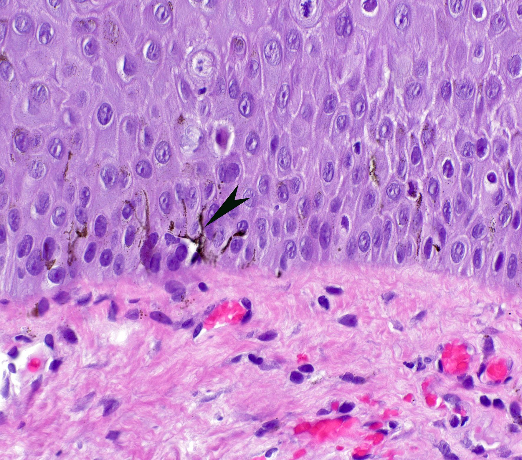 Anal biopsy with pigment and HSIL (high-grade squamous intraepithelial lesion, H&E, original magnification 40×).