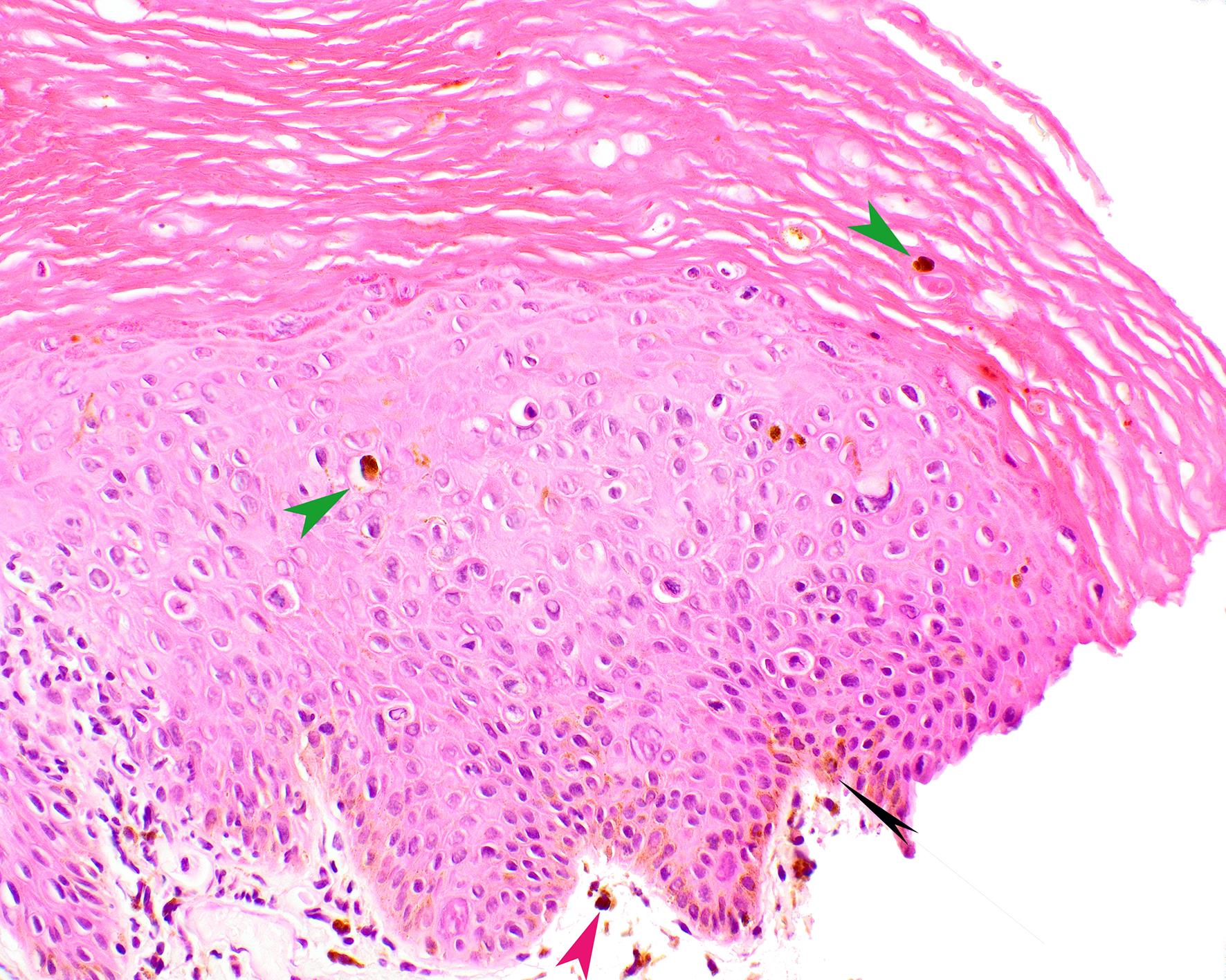 Anal biopsy with pigment and HSIL (high-grade squamous intraepithelial lesion, H&E, original magnification 40×).