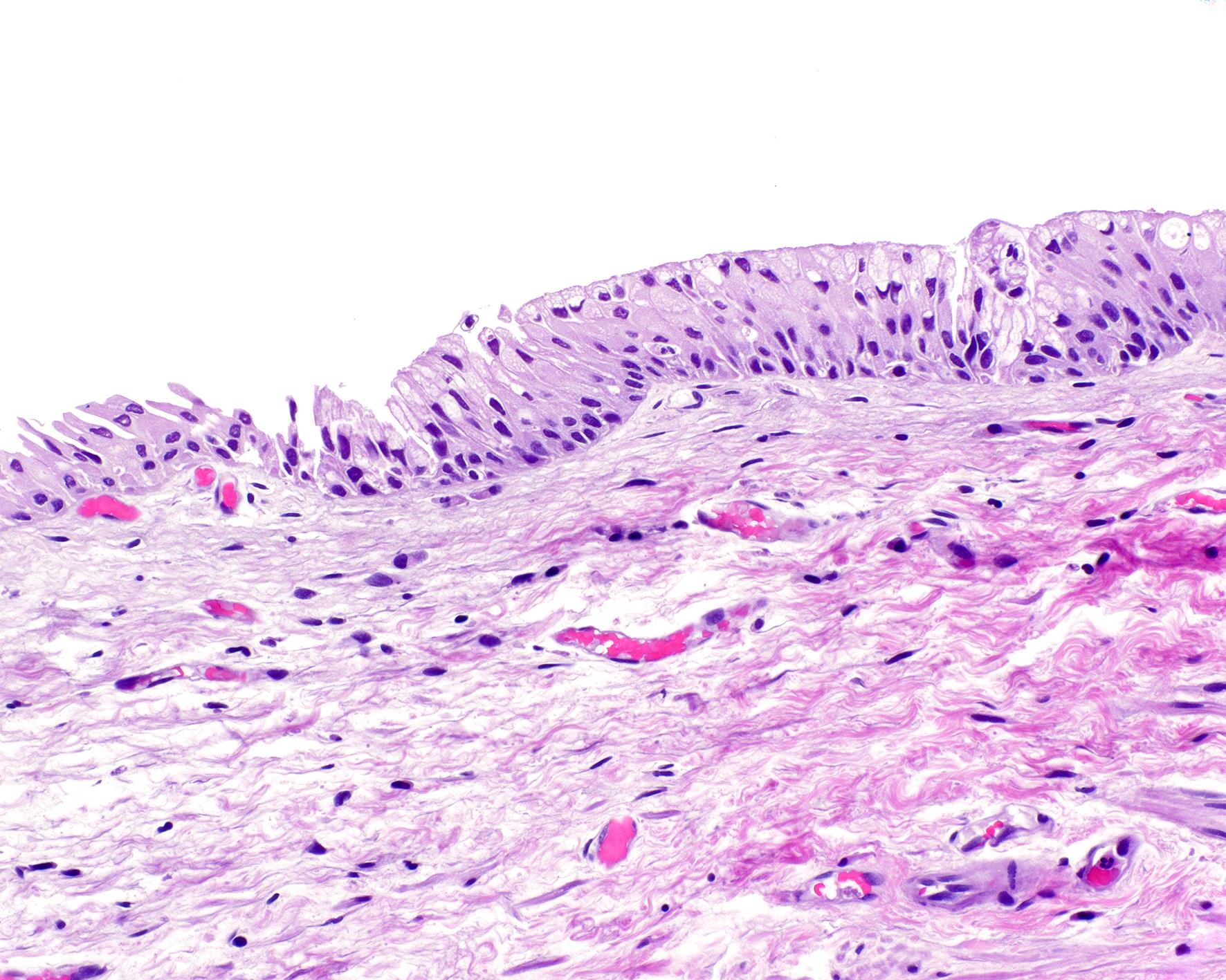 Anal transitional zone biopsy without pigment (H&E, original magnification 40×).
