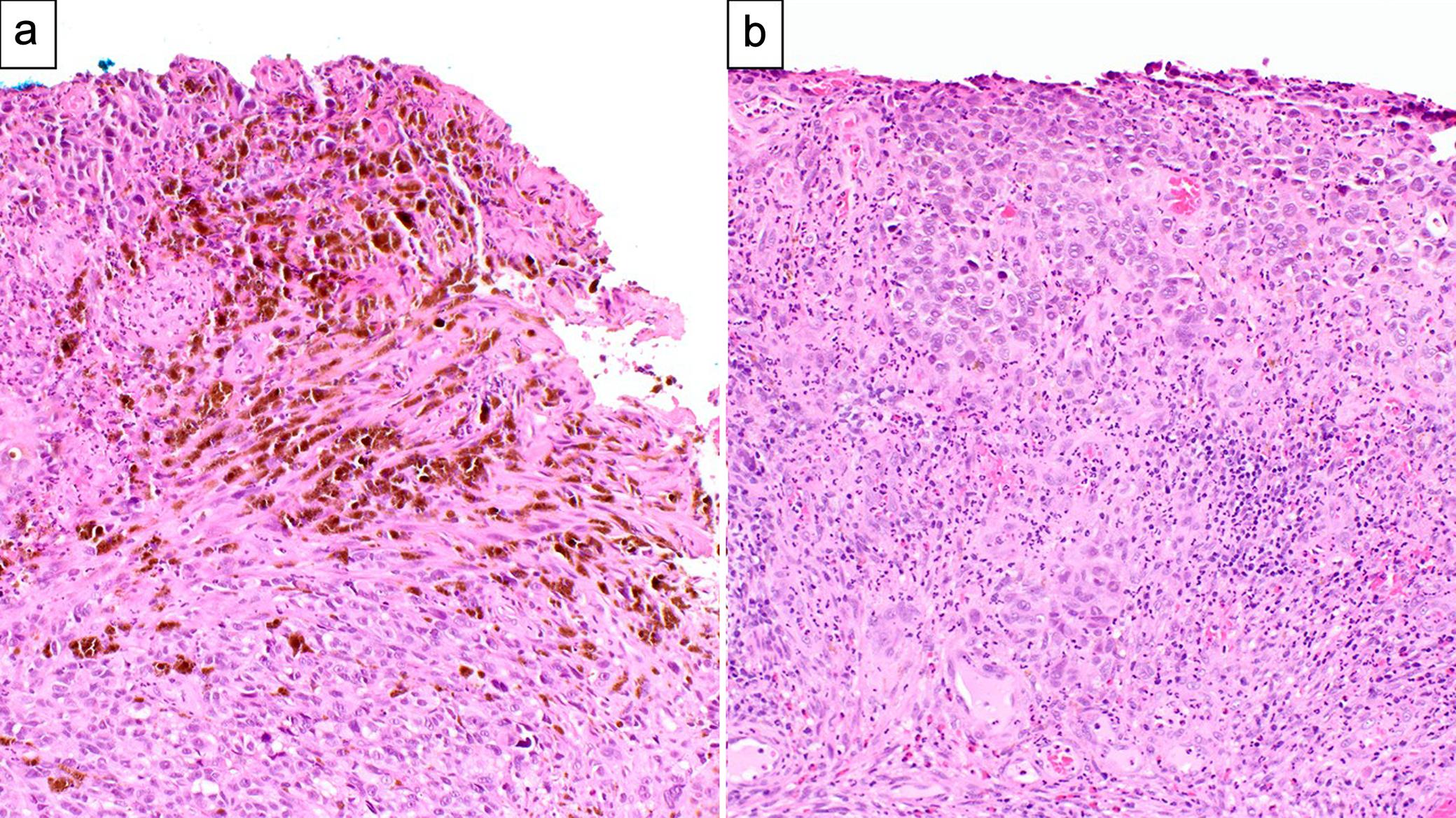Anal melanomas.