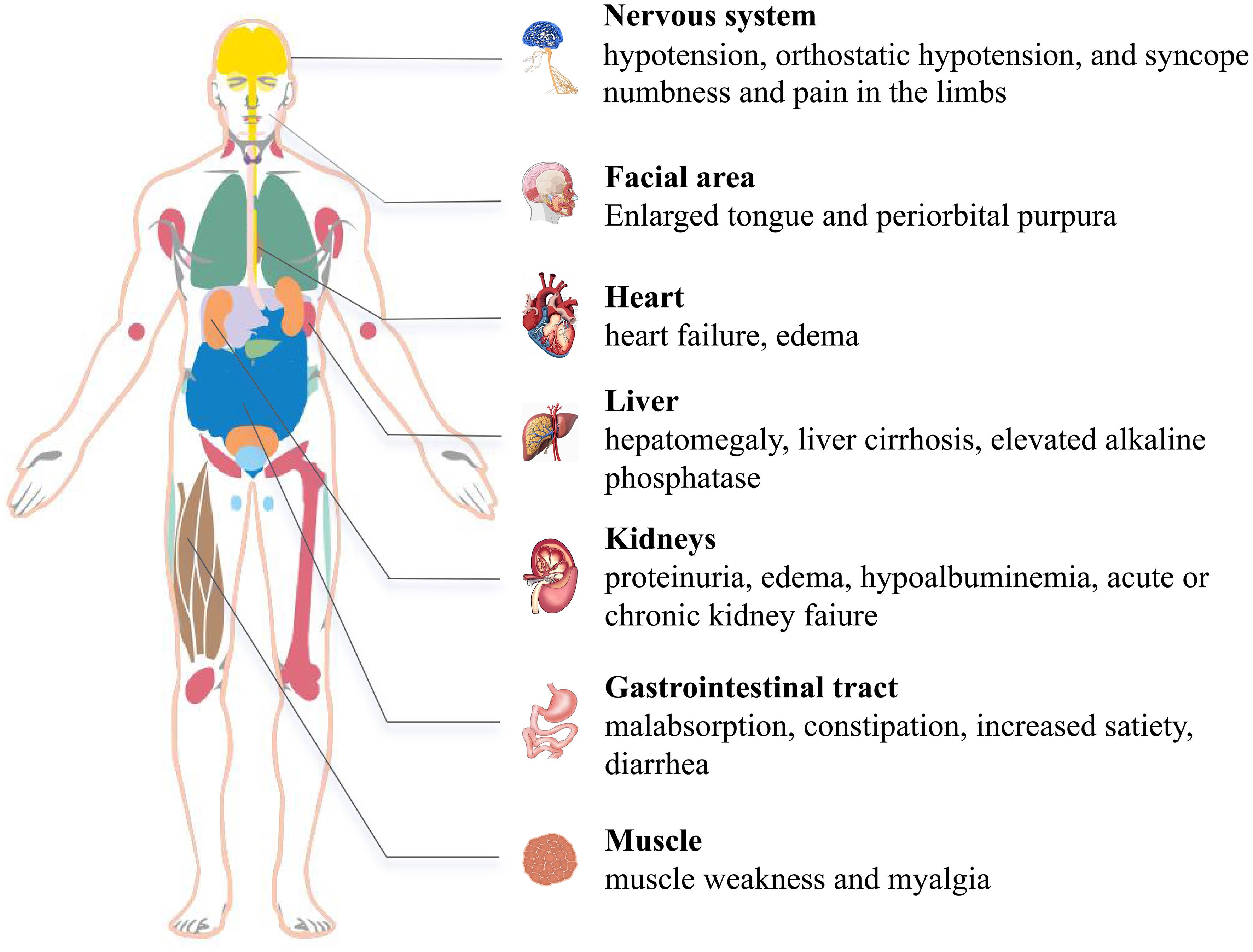 Clinical manifestation of systemic light chain (AL) amyloidosis.