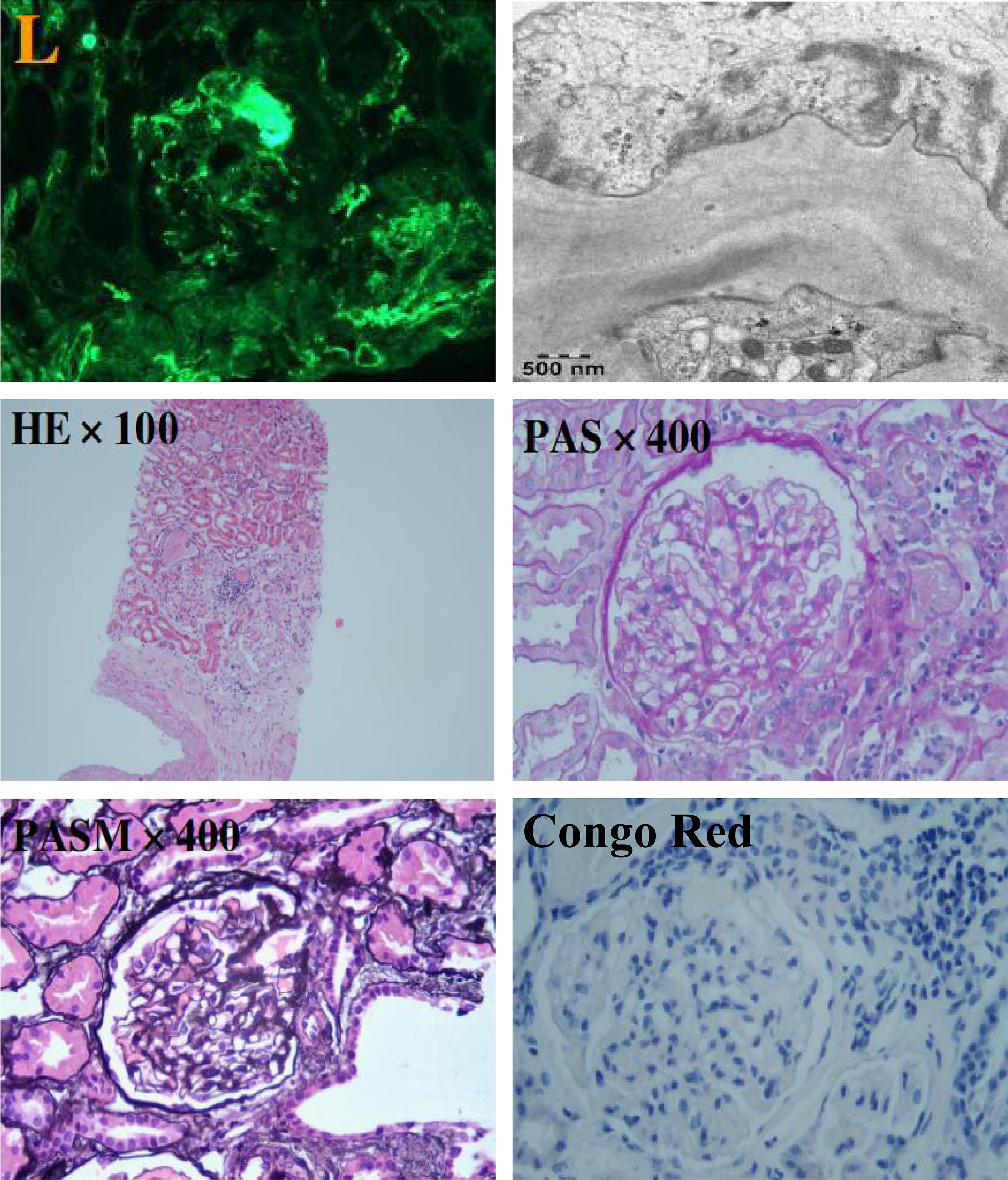 Kidney biopsy pathological picture of systemic light chain (AL) amyloidosis.