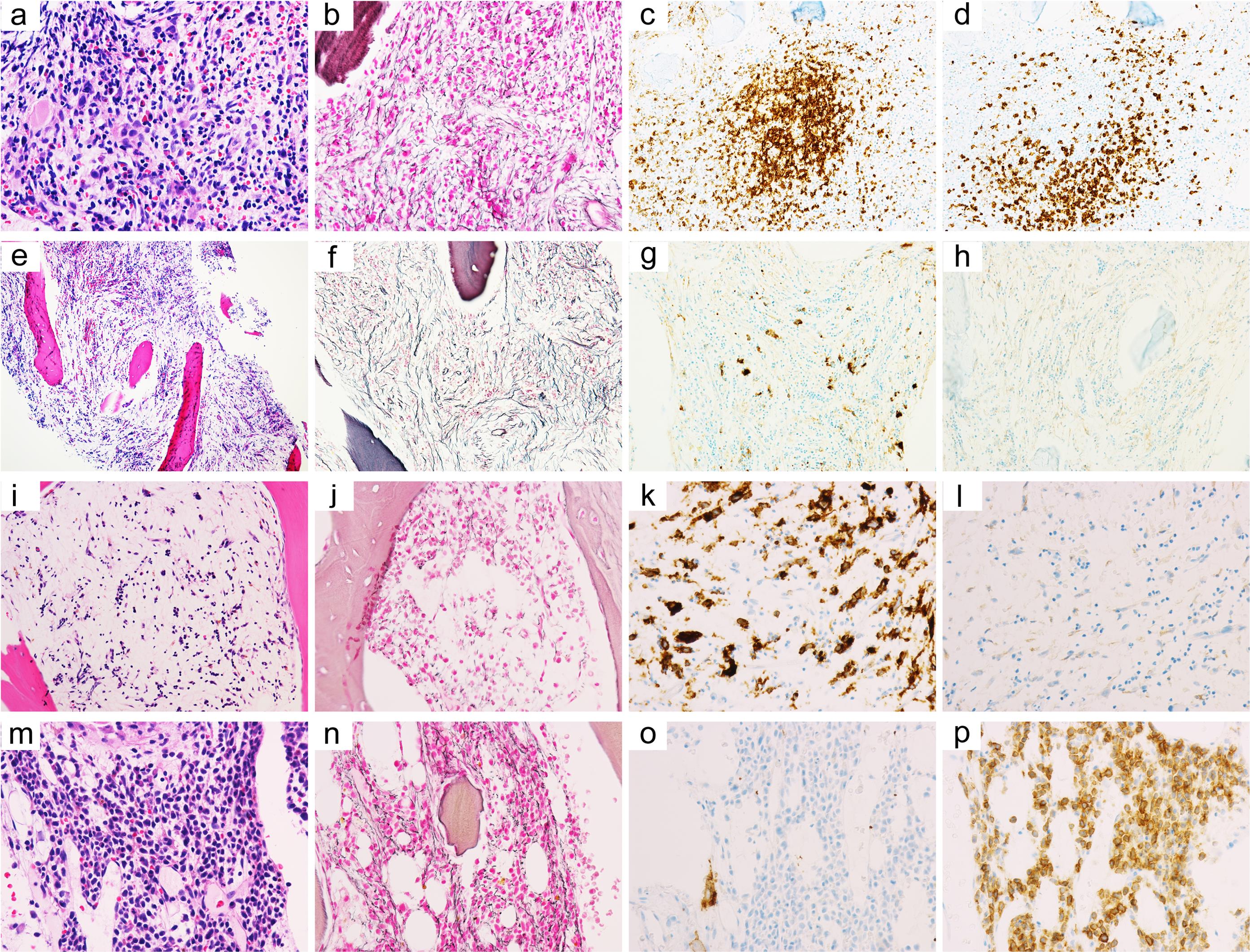 Acute myeloid leukemia was established after multiple bone marrow biopsies in a child with cytopenia and bone marrow fibrosis.