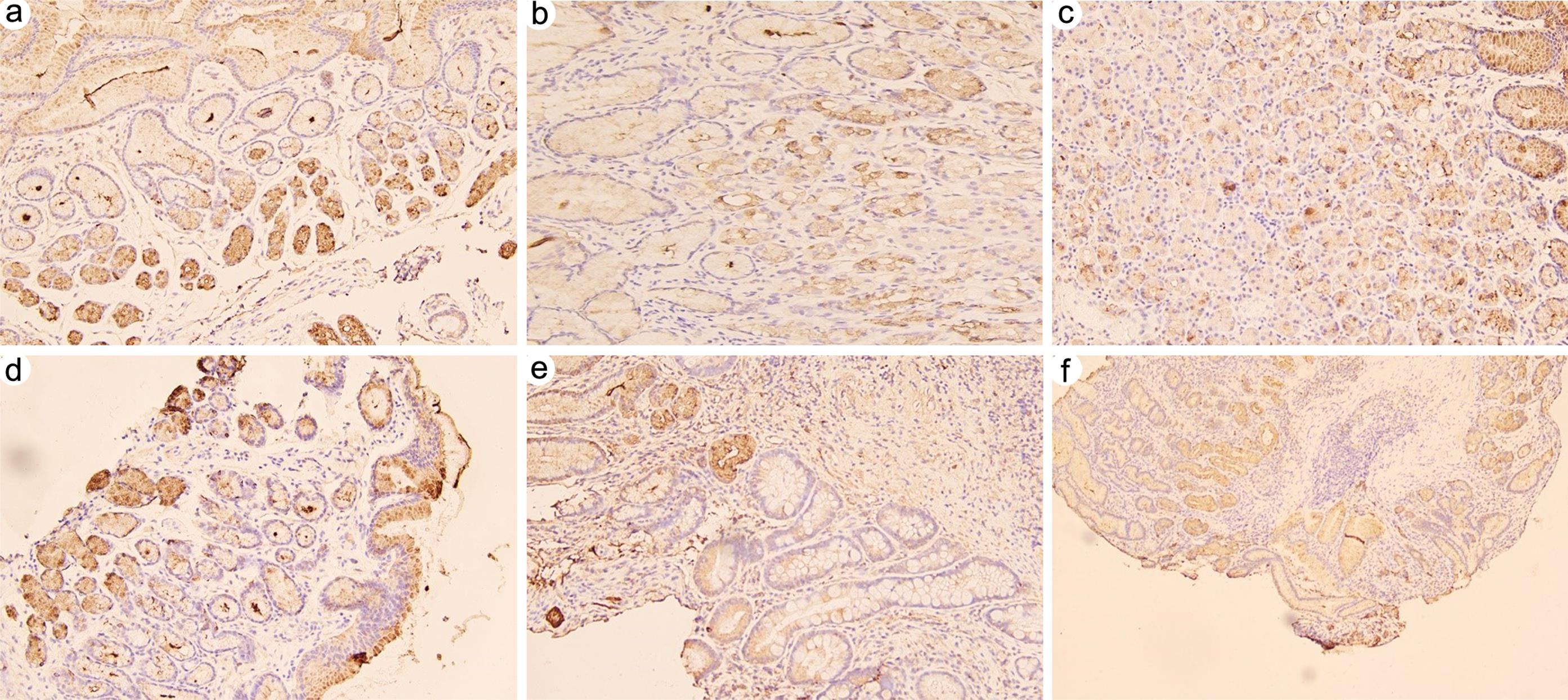Immunohistochemical staining of trefoil factor 2 (TFF2) in normal gastric mucosa and gastric mucosa with antralization or precancerous lesions.