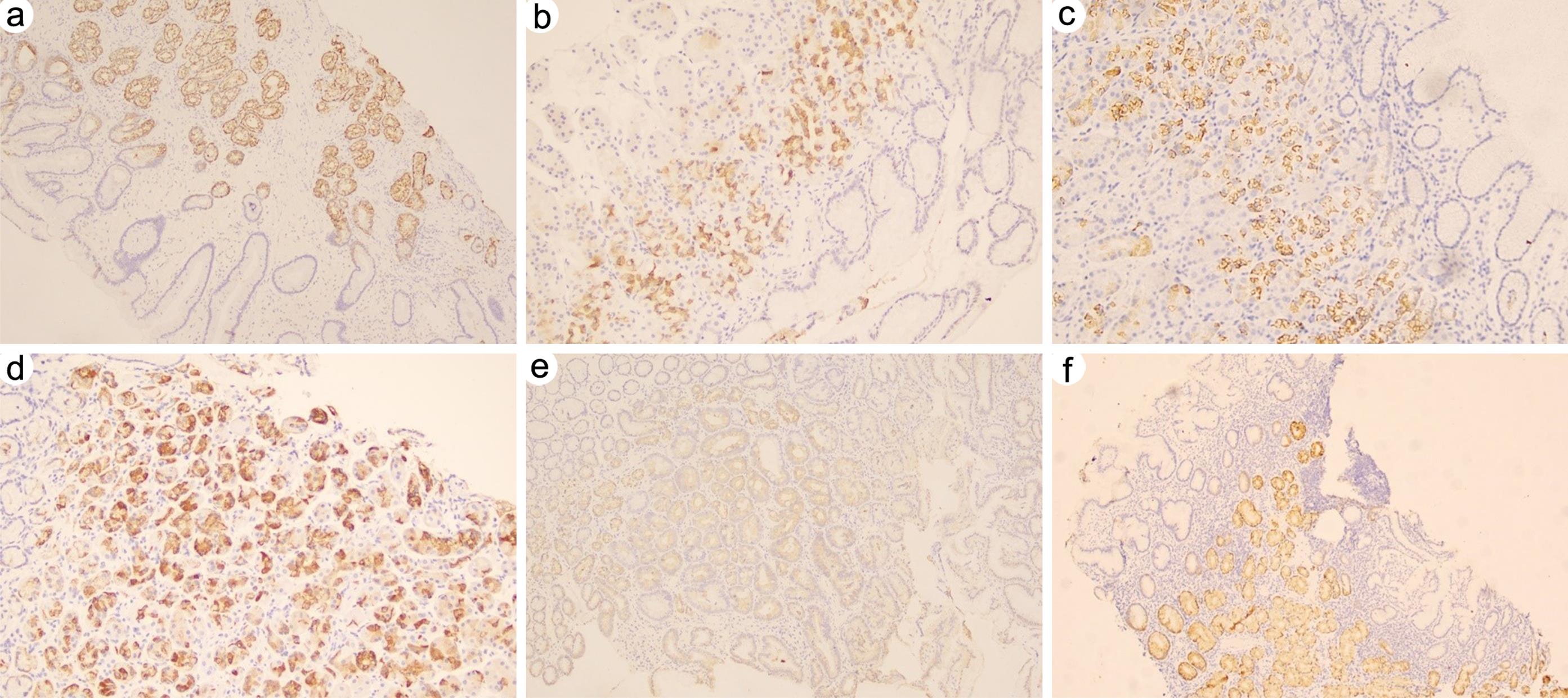 Immunohistochemical staining of mucin 6 (MUC6) in normal gastric mucosa and gastric mucosa with antralization or precancerous lesions.