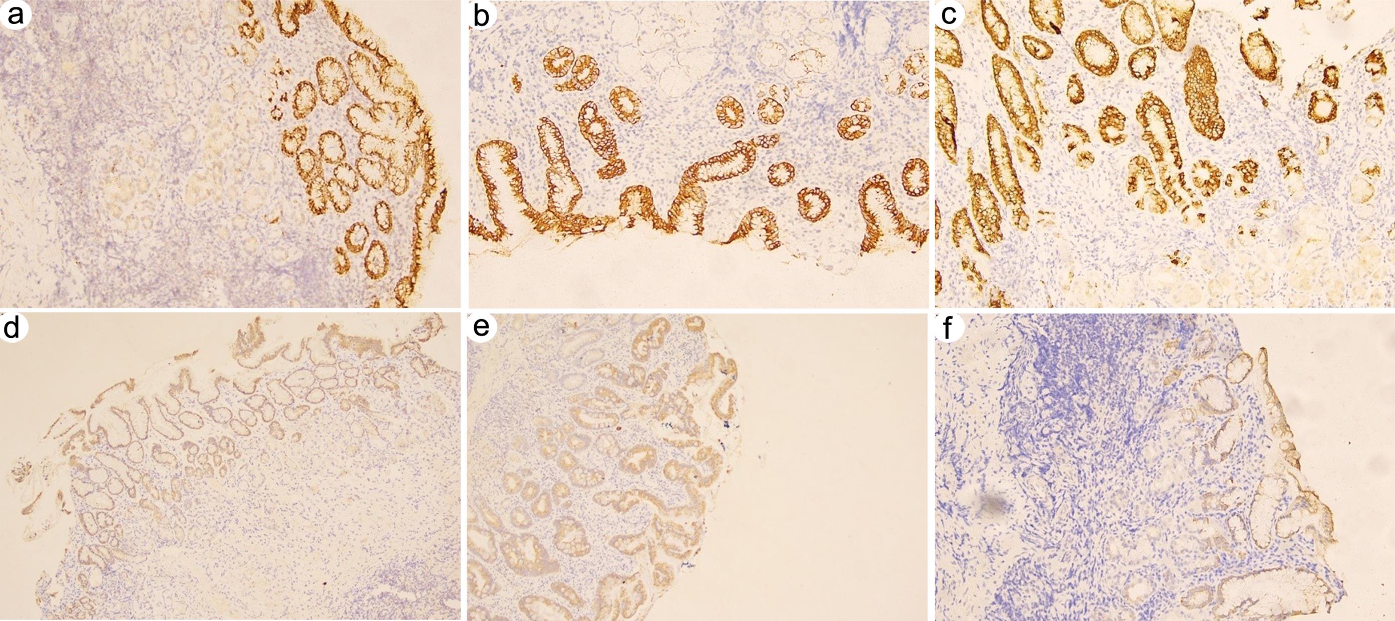 Immunohistochemical staining of mucin 5AC (MUC5AC) in normal gastric mucosa and gastric mucosa with antralization or precancerous lesions.