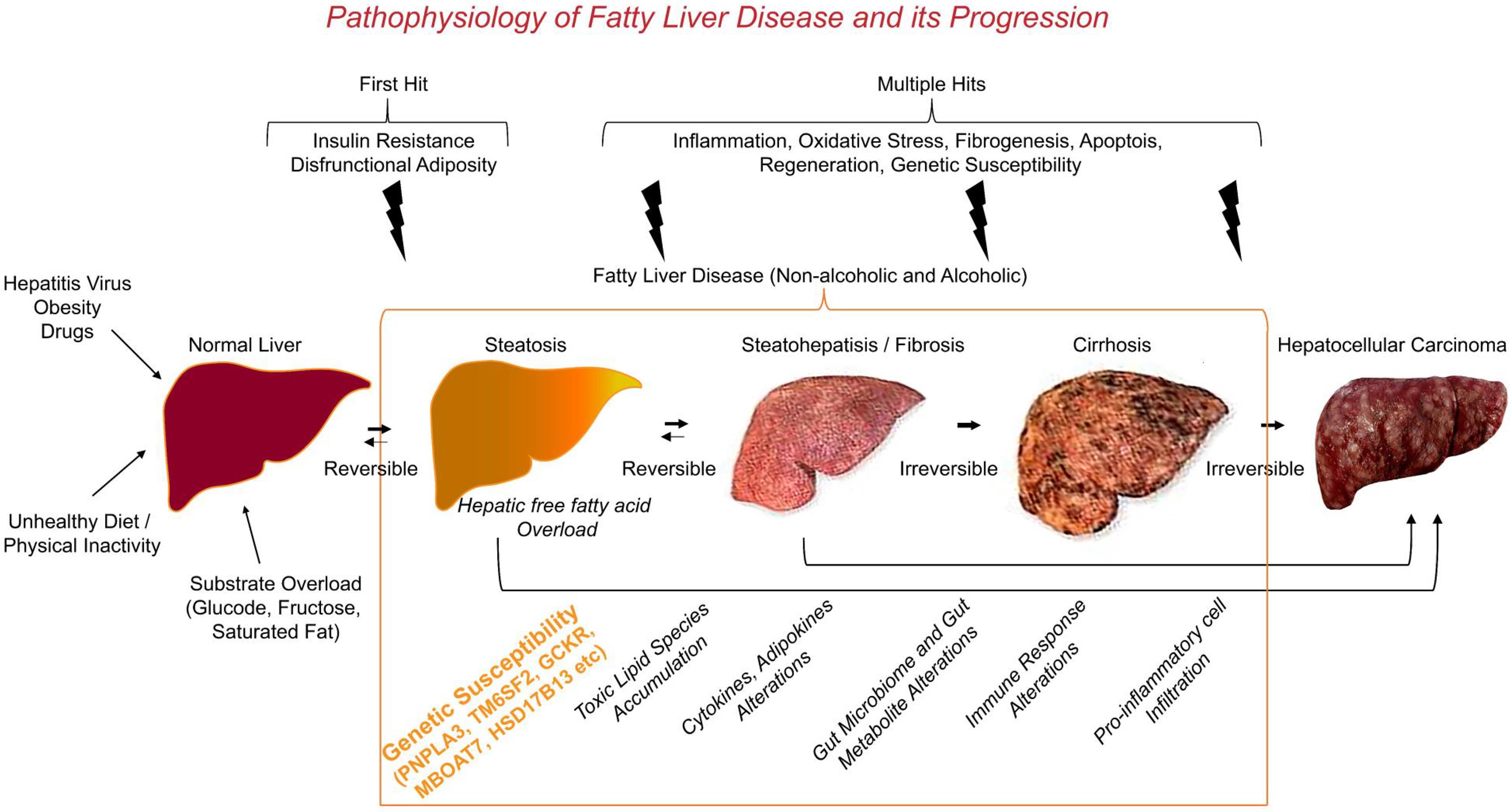 Evolution Of Non alcoholic Fatty Liver Disease To Liver Cancer Evolution Of Non alcoholic Fatty Liver Disease To Liver Cancer