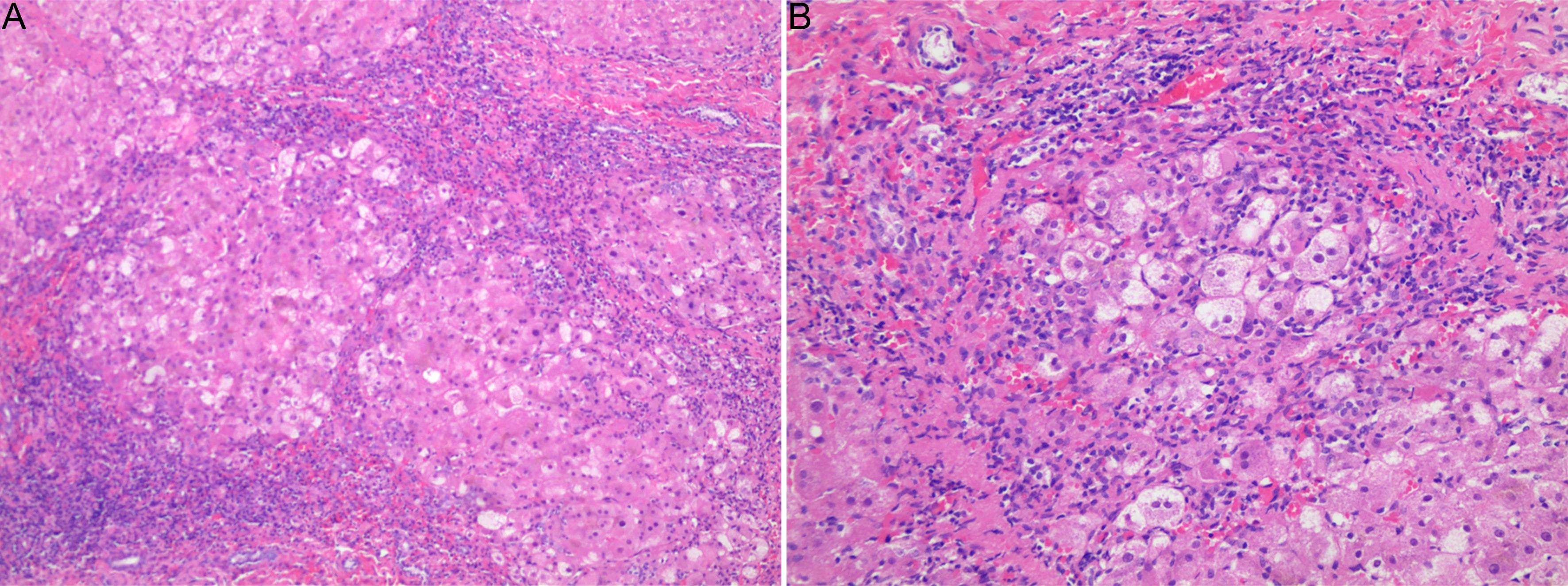 Liver histological manifestations of WD patients.