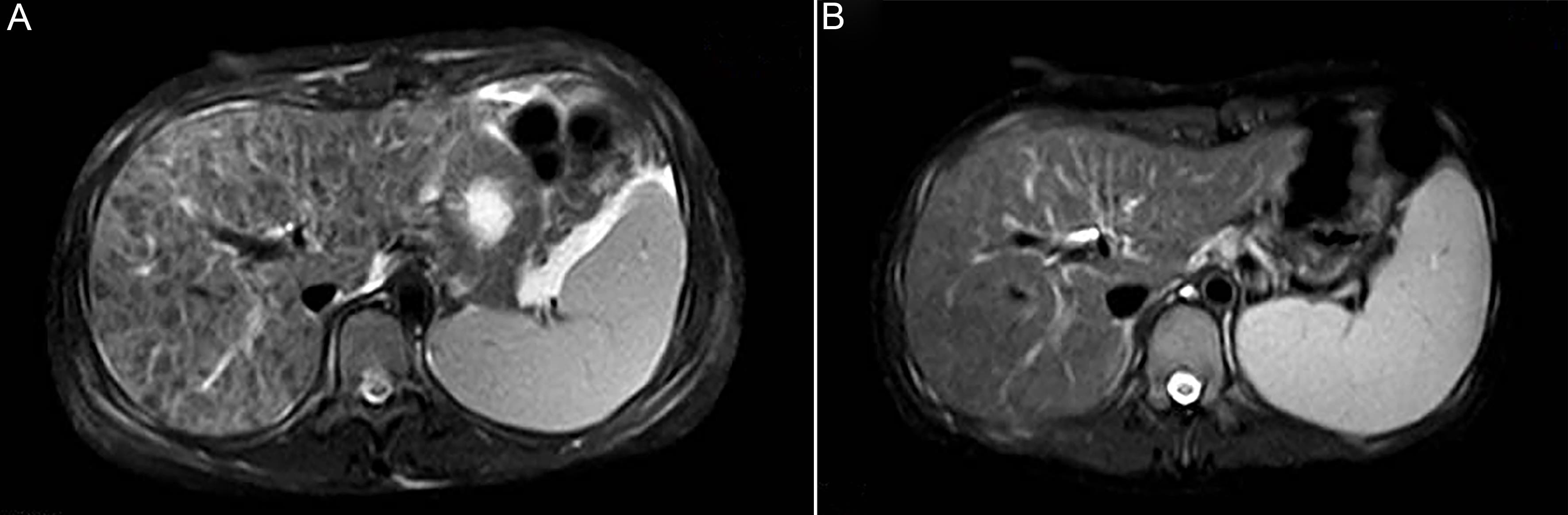 Imaging findings of the patient before and after treatment.