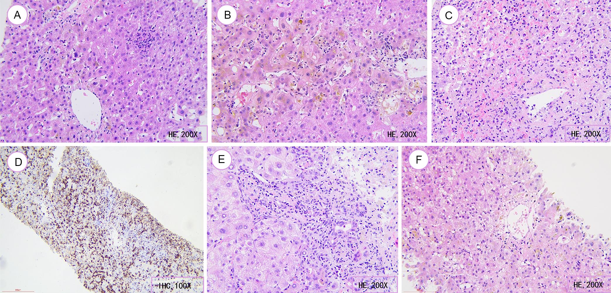 Common histopathological features of immune checkpoint inhibitor-mediated liver injury.