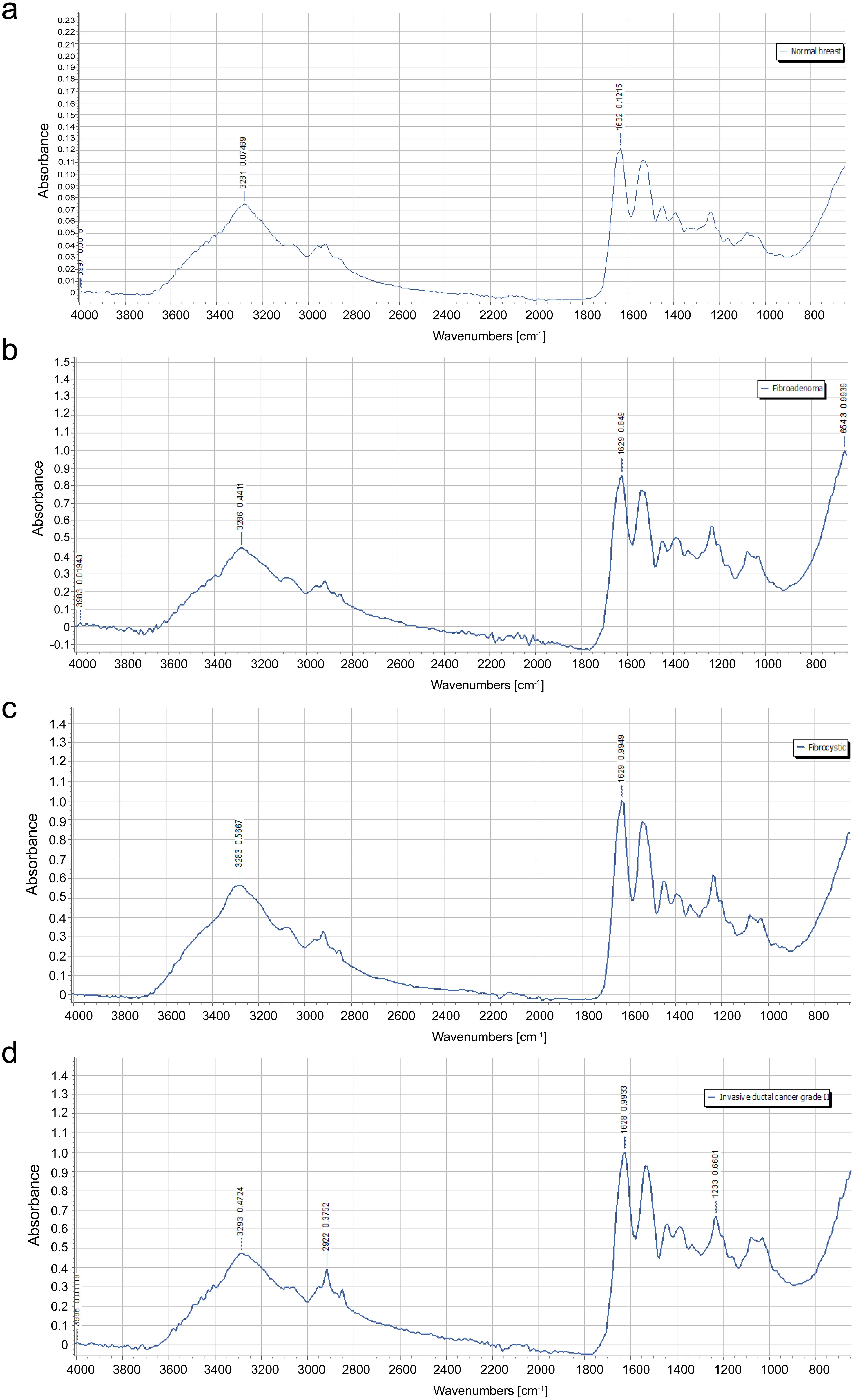 Spectra of (a) normal breast tissue showing peak positions and peak intensities, (b) breast fibroadenoma showing peak positions and peak intensities, (c) fibrocystic breast disease showing peak positions and peak intensities, (d) invasive breast cancer grade 2 showing peak positions and peak intensities.