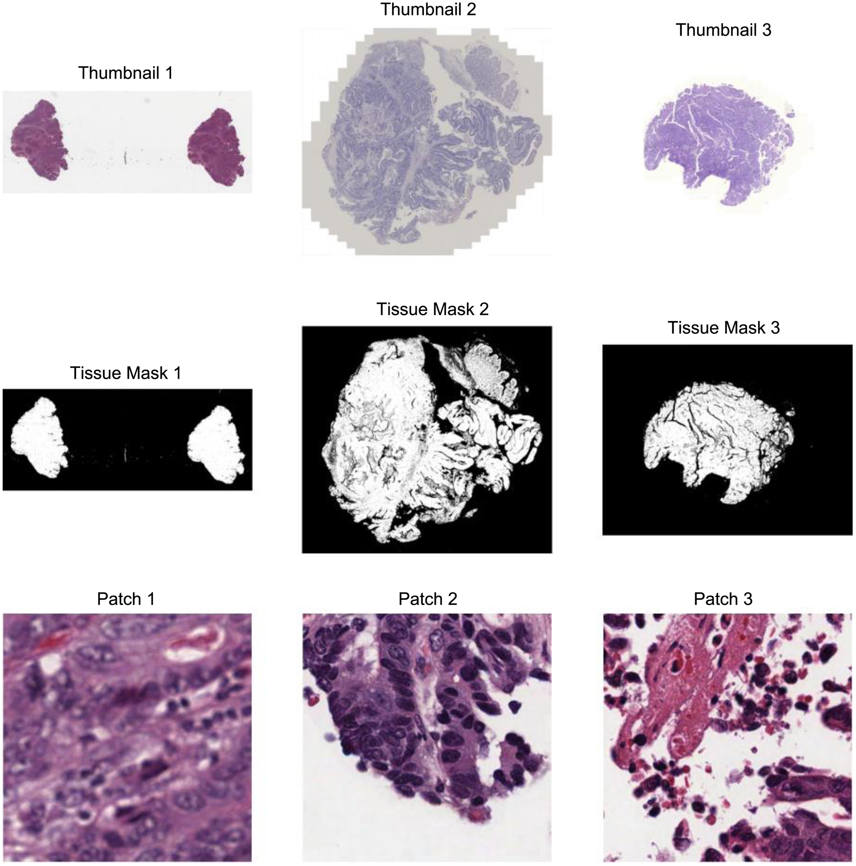 Whole Slide Image (WSI) preprocessing and patch feature visualization of precancerous and malignant rectal lesions.