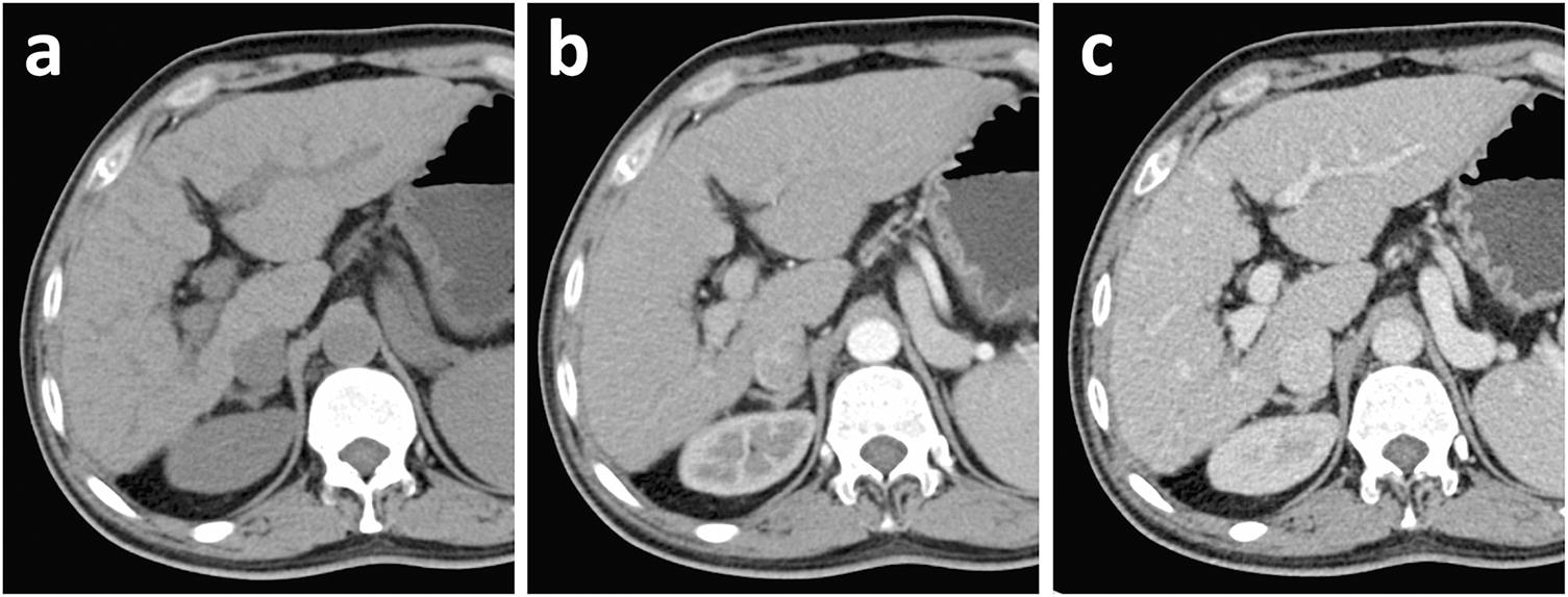 Morphologic liver changes in a 51-year-old male patient diagnosed with HBV-related liver cirrhosis.