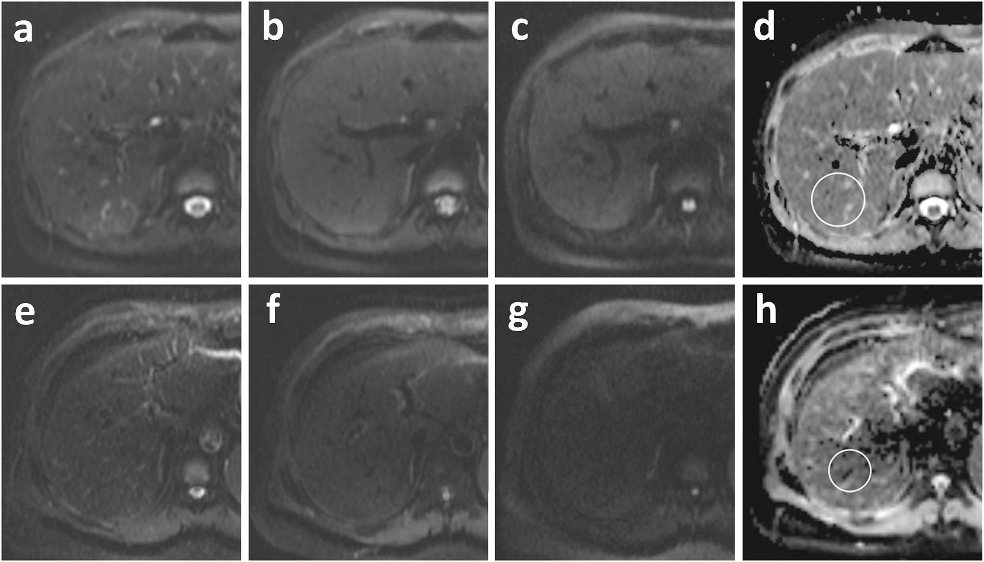 Diffusion-weighted MR imaging in a 29-year-old female with normal liver (a-d) and a 44-year old male with liver cirrhosis (e-h).