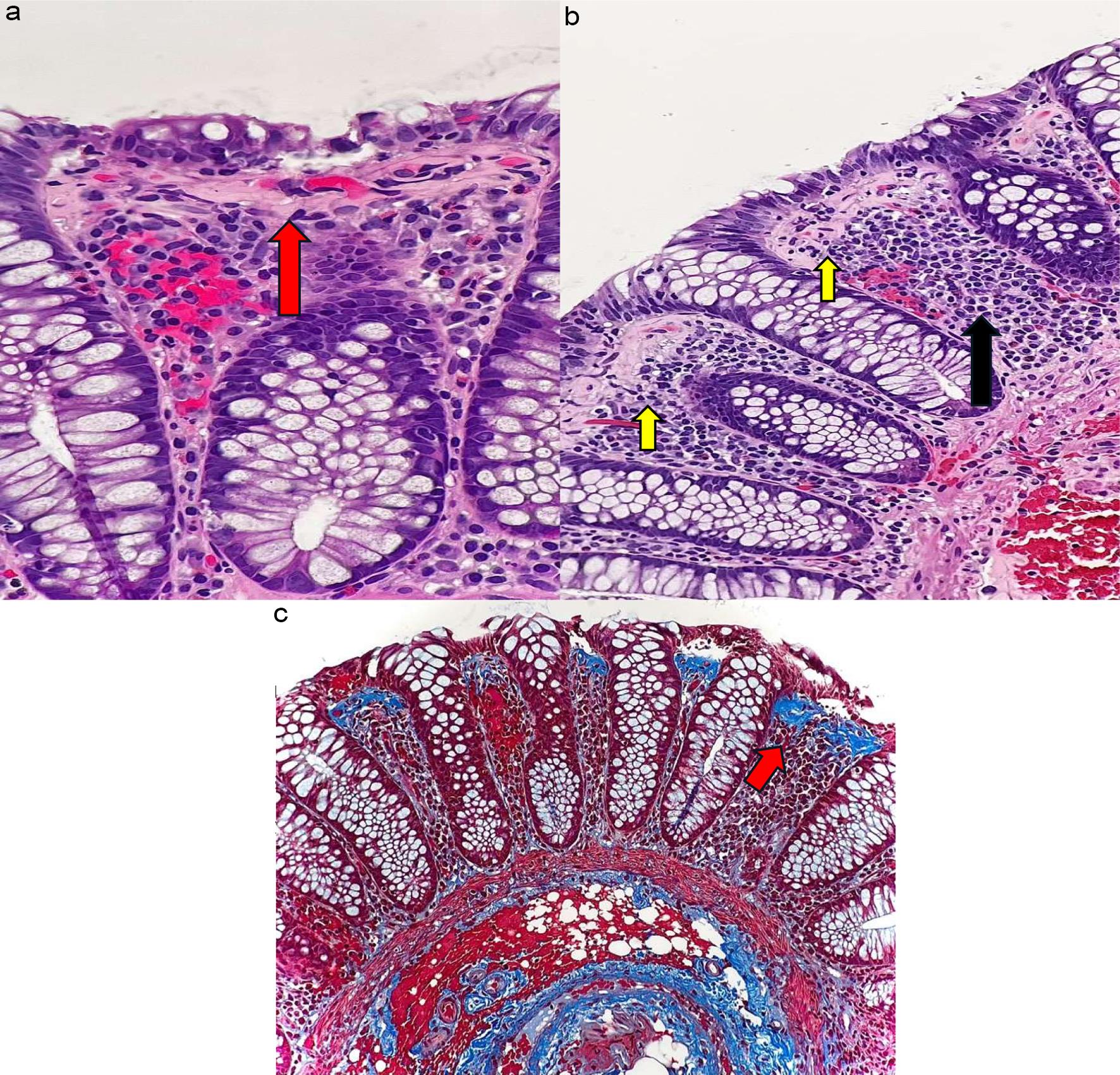 Collagenous colitis.
