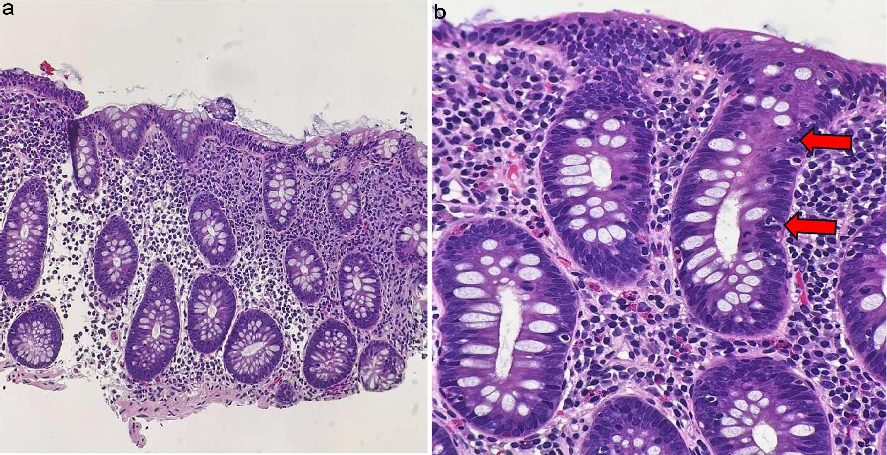 Lymphocytic colitis.