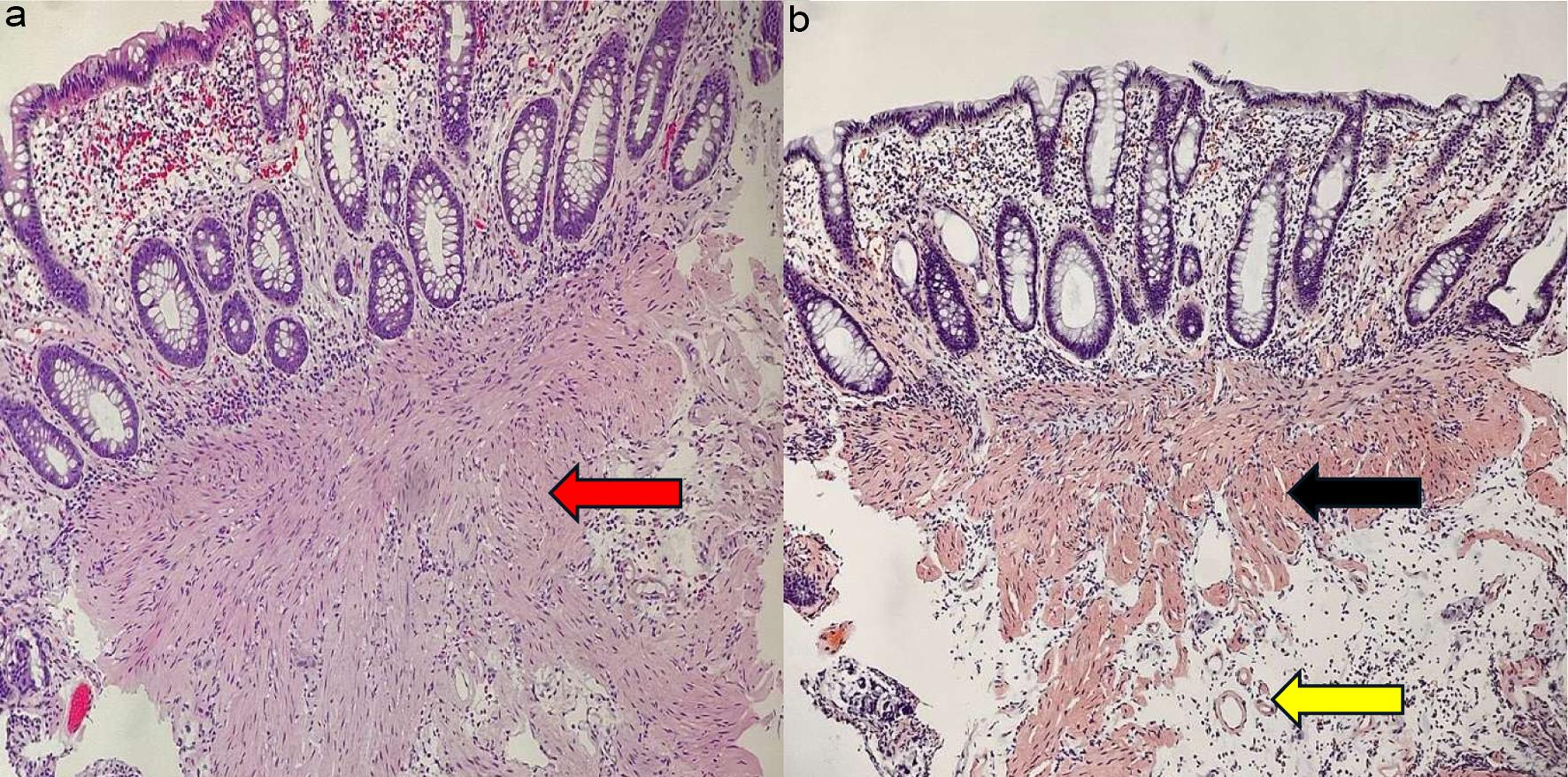 Amyloidosis.