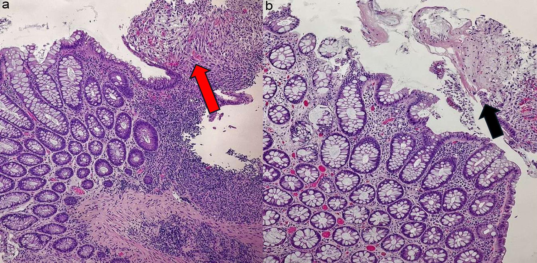 Radiation colitis.