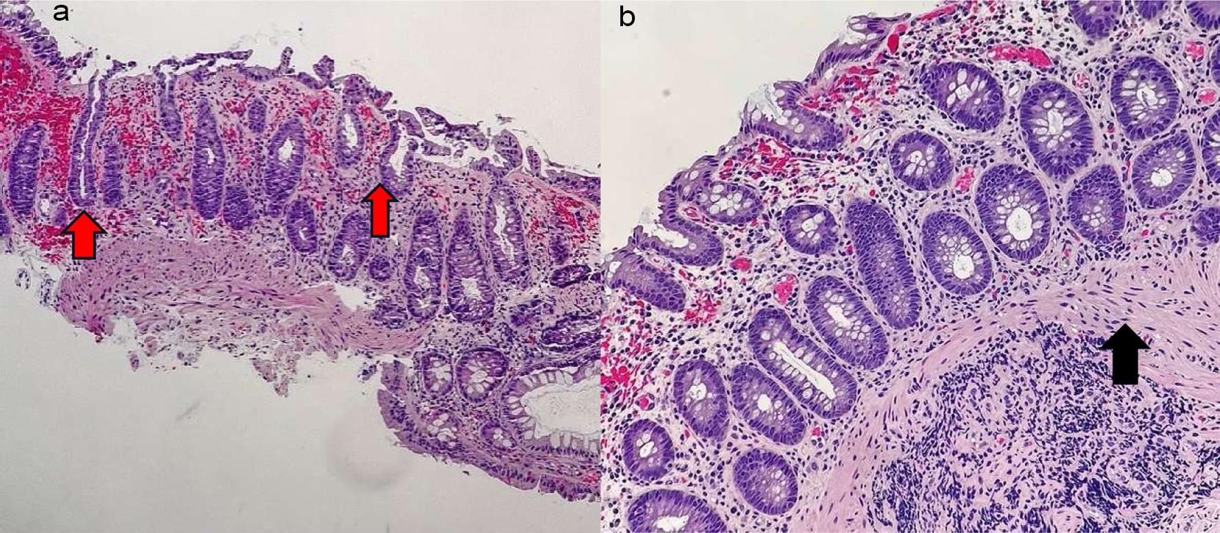 Early ischemic colitis.