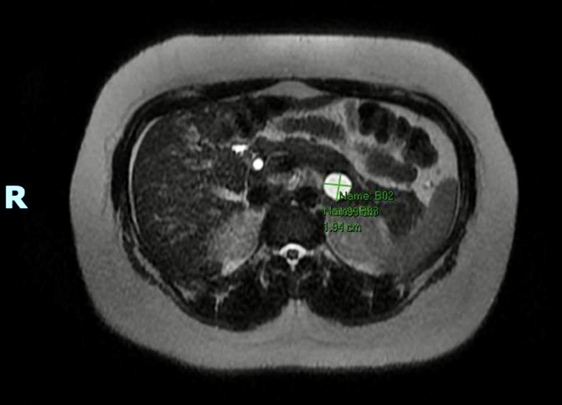 MRI showing significantly increased pancreatic cyst in 2024.