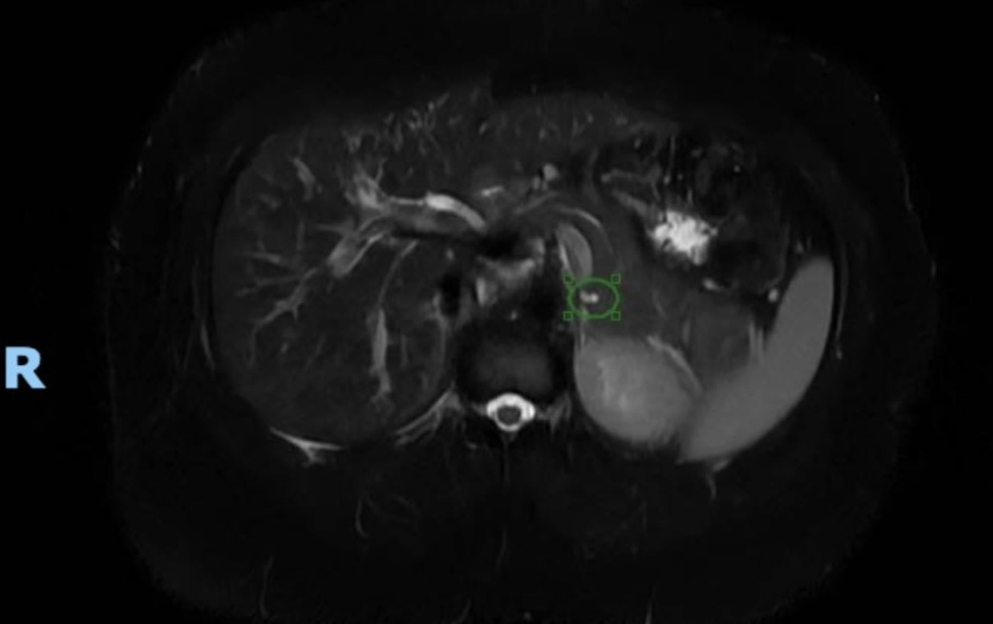 MRI showing initial finding of pancreatic cyst in 2022 with dimensions of 0.6 × 0.3 cm.