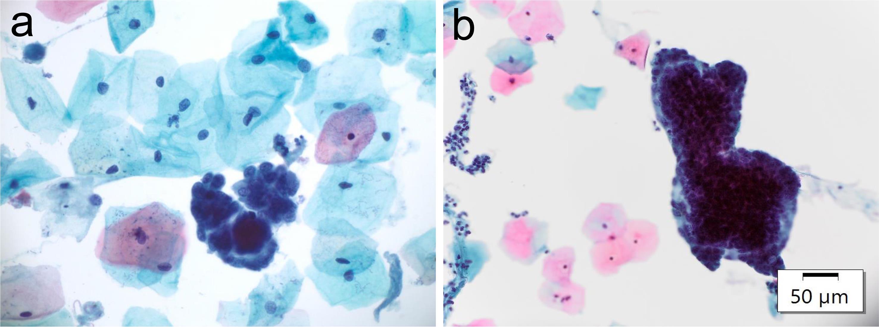 Clusters of benign endometrial cells forming a 3-dimention (3D) glandular configuration (a–b).