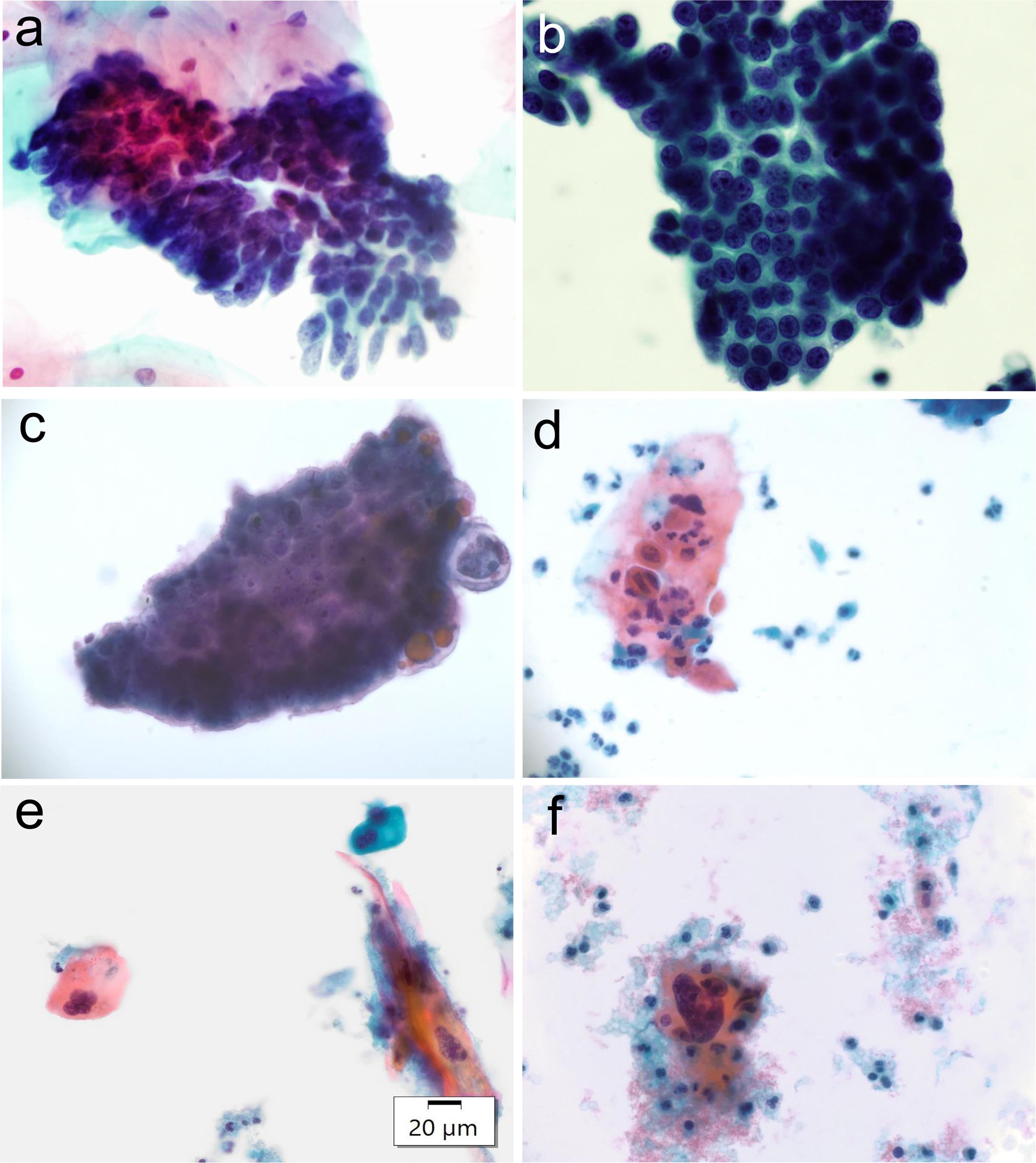 (a) Adenocarcinoma <italic>in situ</italic> with feathering endocervical glandular arrangements. (b–c) Adenocarcinoma: NOS cells forming a glandular architecture with nuclear overlapping crowding, and hyperchromasia. (d–f) Squamous cell carcinoma presenting orangeophilic tumor cells with an irregular nuclear contour, hyperchromasia, and tadpole features in the background of the tumor diathesis.