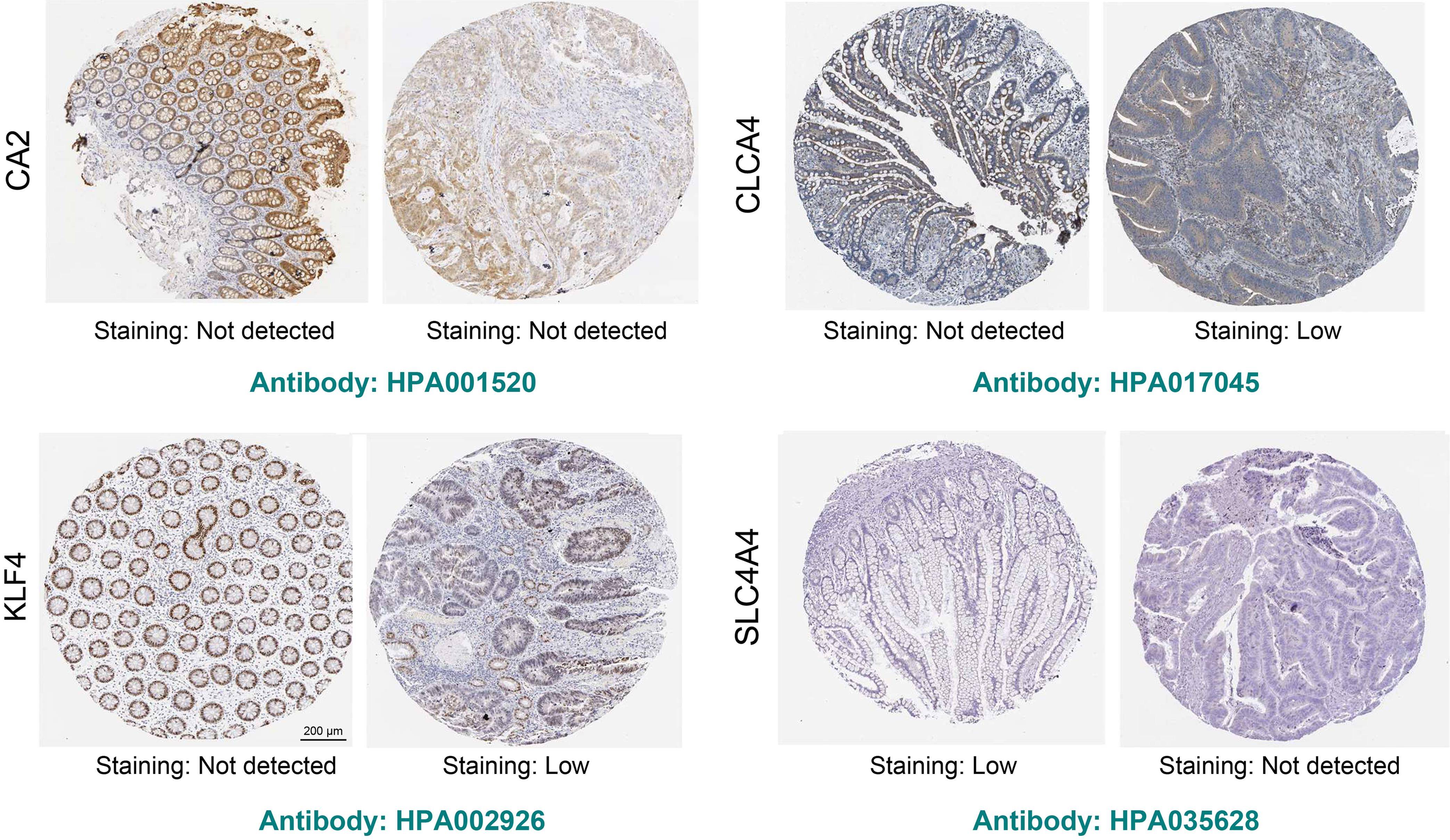 Validation of the four hub genes (<italic>CA2</italic>, <italic>CLCA4</italic>, <italic>KLF4</italic>, and <italic>SLC4A4</italic>) in normal and tumor tissues using immunohistochemical staining data from the Human Protein Atlas database.