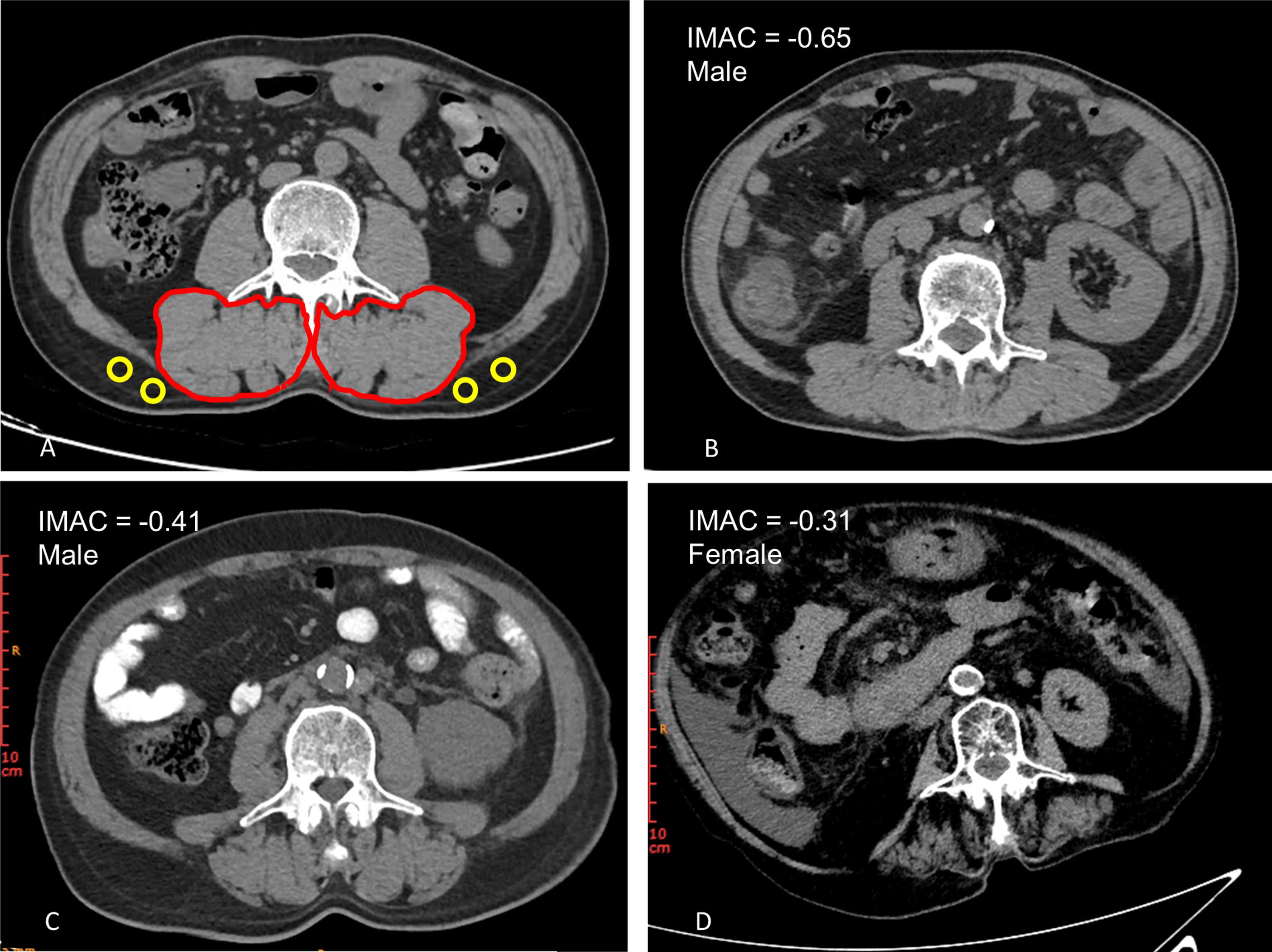 Abdominal computed tomography images taken at the third lumbar vertebra to quantify intramuscular adipose tissue and muscle radiodensity in patients with cirrhosis.