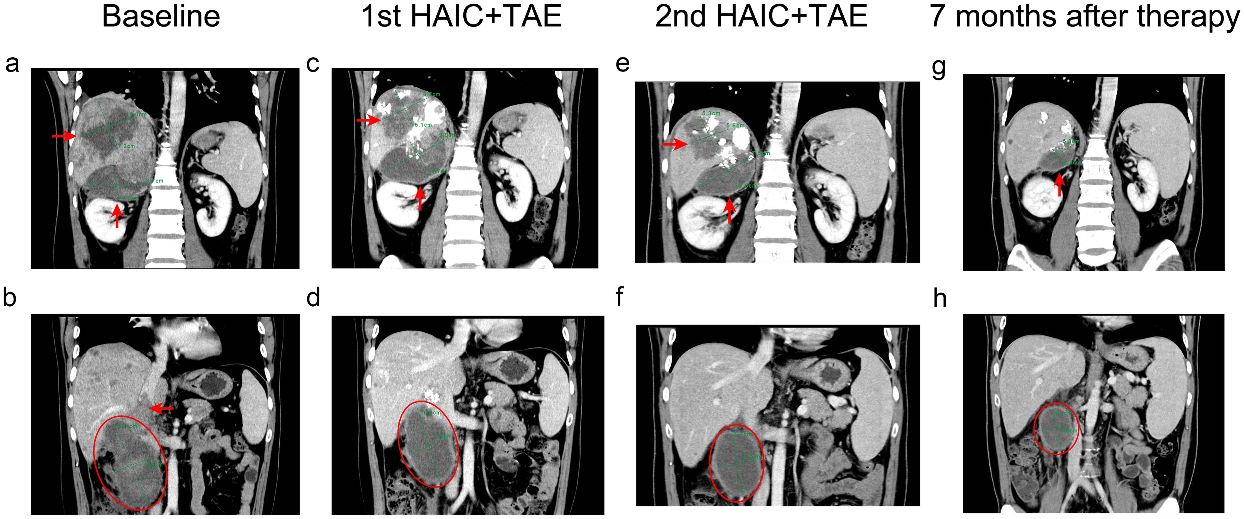 Computed tomography images of tumors in the liver.