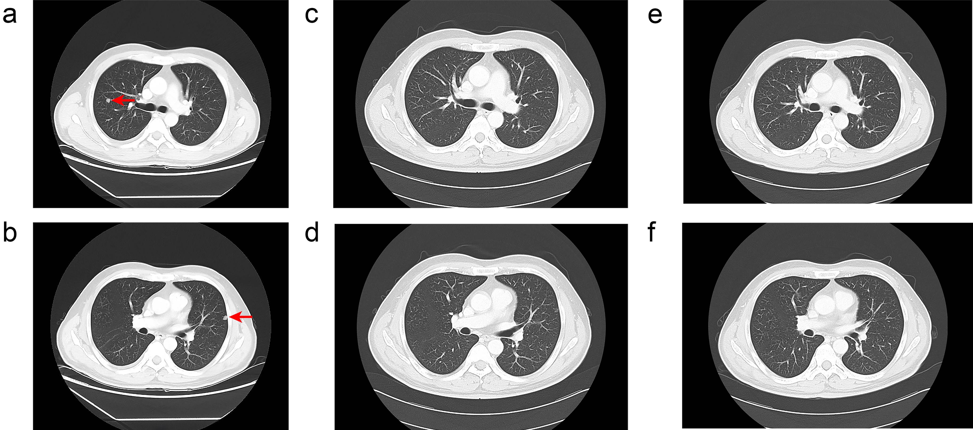 Computed tomography images of the lung showing pulmonary metastases at different time points.