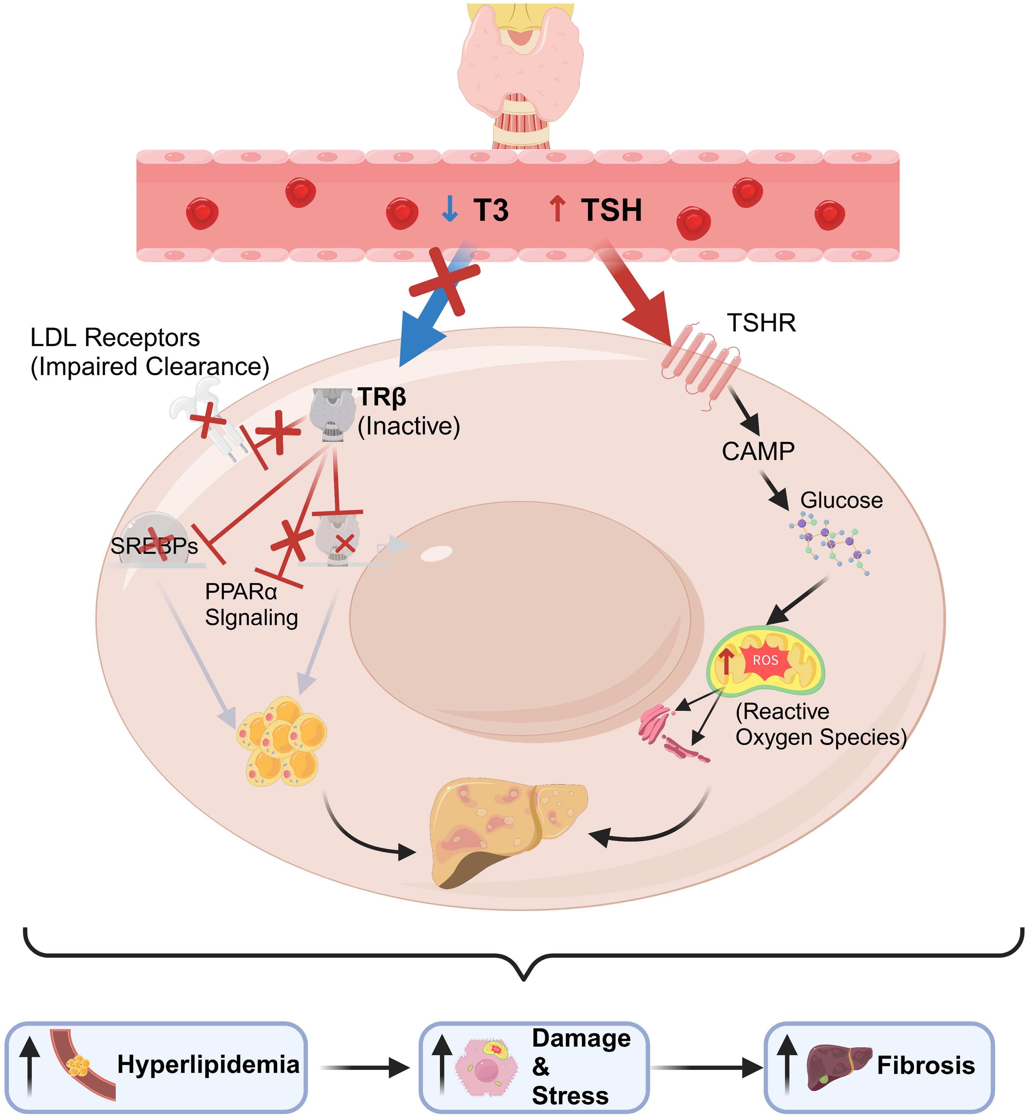 Pathogenic mechanisms linking hypothyroidism to hepatic steatosis and fibrosis progression.