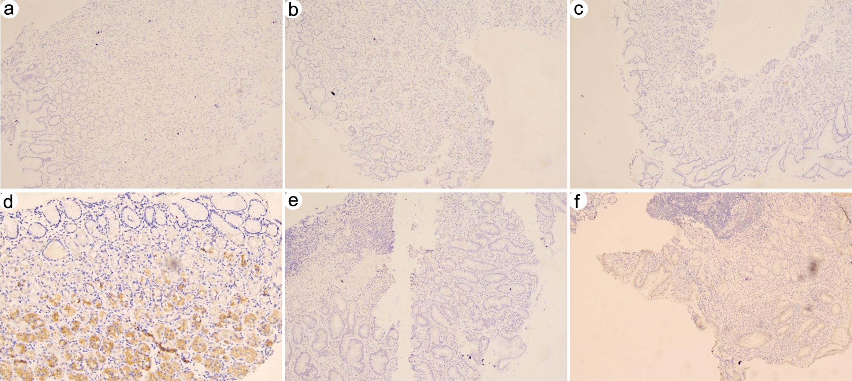 Immunohistochemical staining of mucin 5B (MUC5B) in normal gastric mucosa and gastric mucosa with antralization or precancerous lesions.