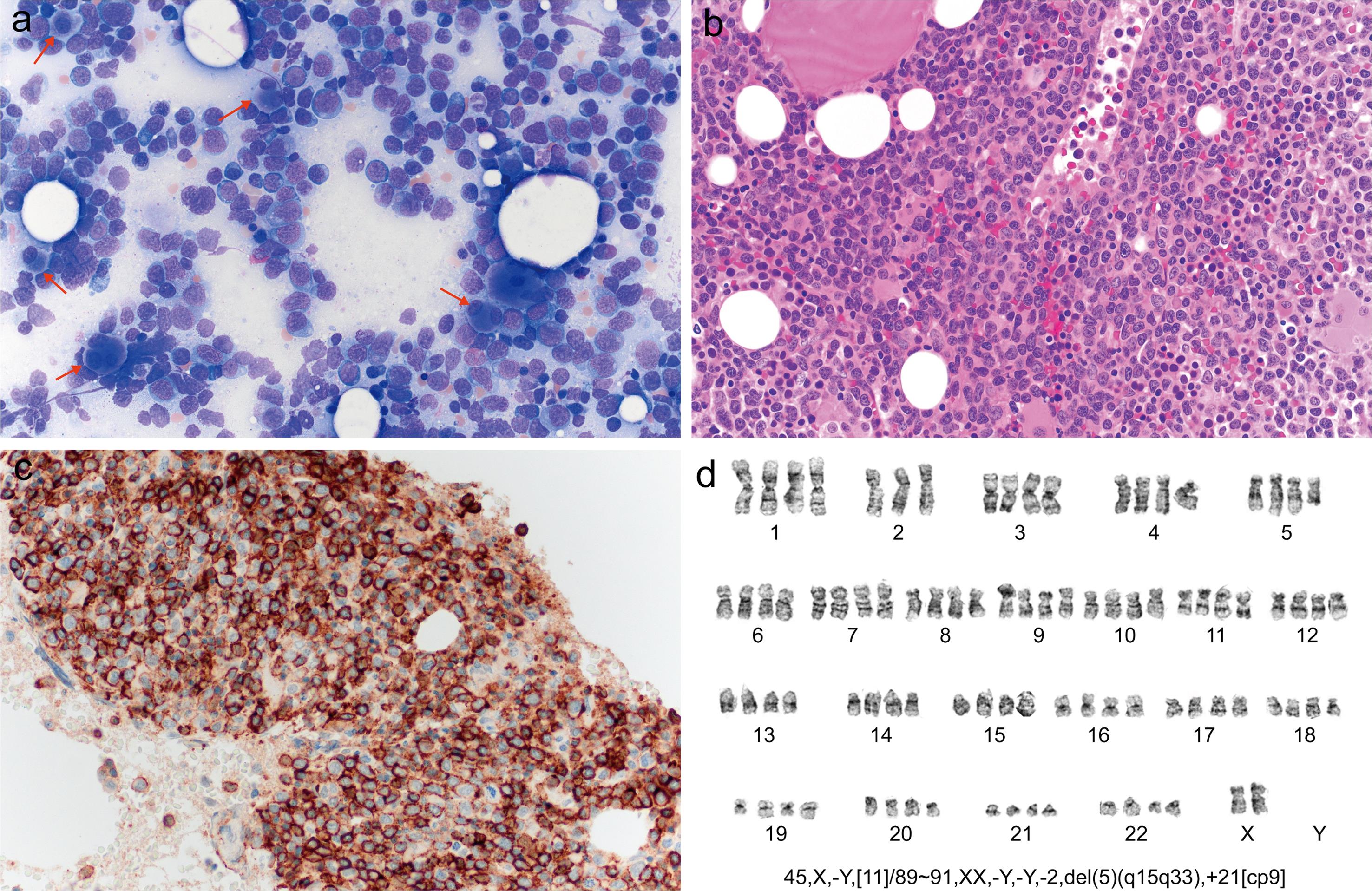 (a) Bone marrow aspirate showing dysmegakaryocytes, red arrows.  May-Grunwald-Giemsa stain, original magnification ×40, red arrows; (b) Bone marrow biopsy, hematoxylin and eosin stain, original magnification ×40; (c) CD43, original magnification ×40; (d) Karyotype.