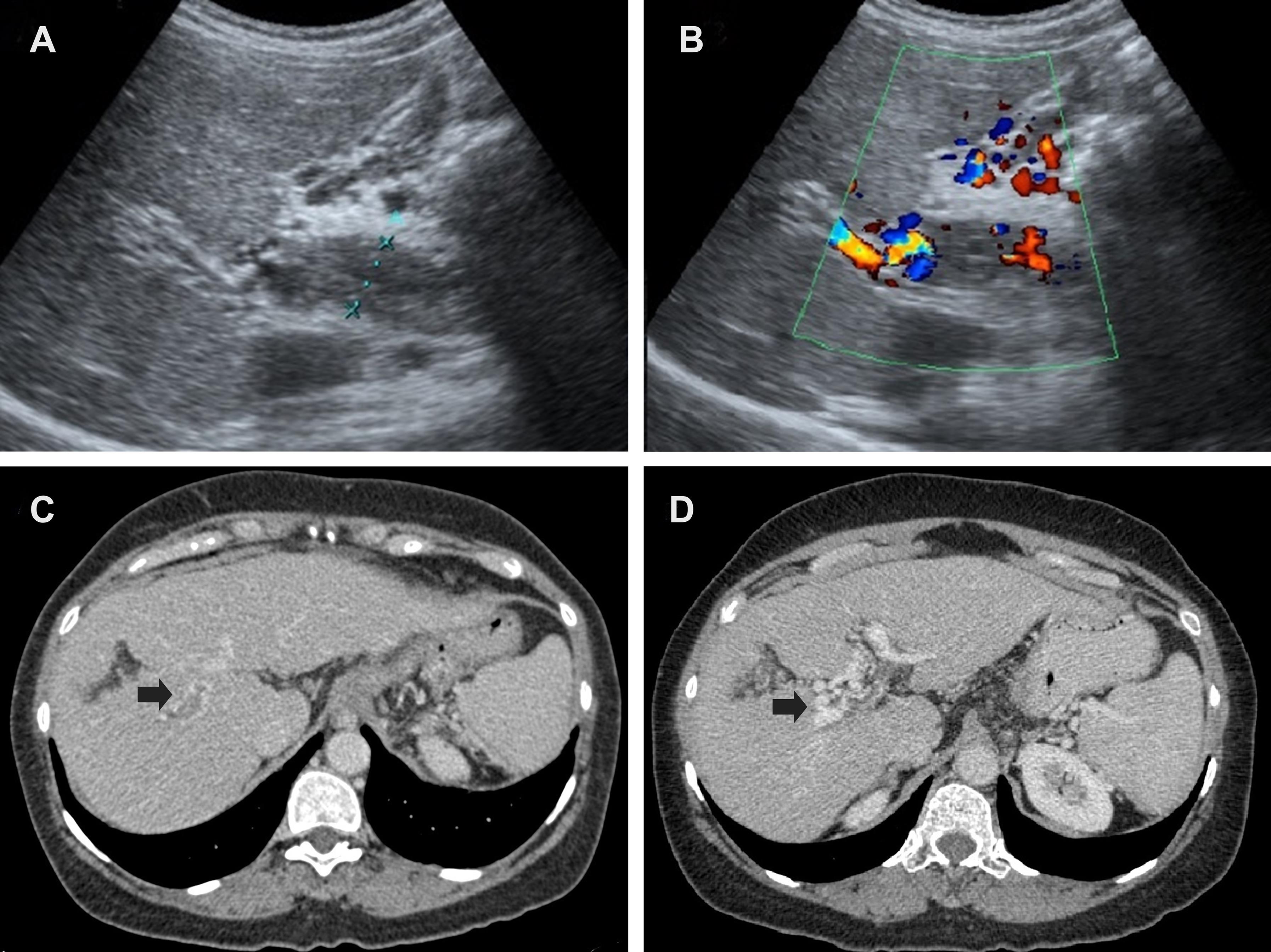 <bold>Imaging findings of nontumoral portal vein thrombosis (PVT) in liver cirrhosis.</bold> (A) Ultrasound of the abdomen shows an echogenic material within the dilated portal vein, indicating PVT. (B) Doppler ultrasound of the abdomen shows decreased color flow within the main portal vein and demonstrates color-filled dilated collateral vessels around the porta hepatis consistent with cavernous transformation. (C) Computed tomography of the abdomen on portal venous phase shows a filling defect in the right branch of the portal vein (arrow), indicating thrombus. (D) Contrast-enhanced computed tomography depicts cavernous transformation (arrow) following portal venous thrombosis.