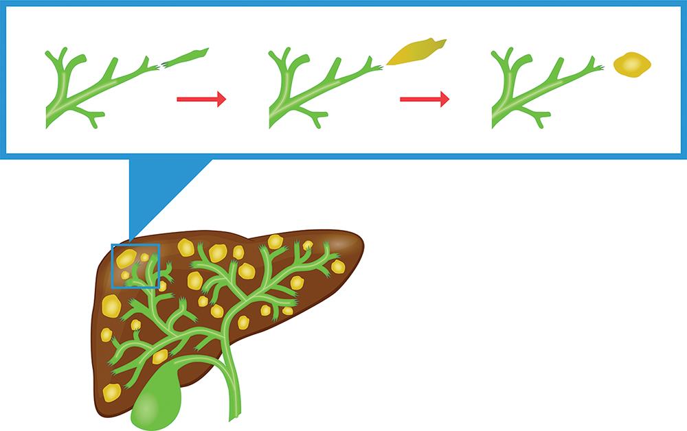 As the biliary tree is formed, the ducts undergo cycles of apoptosis and regeneration.