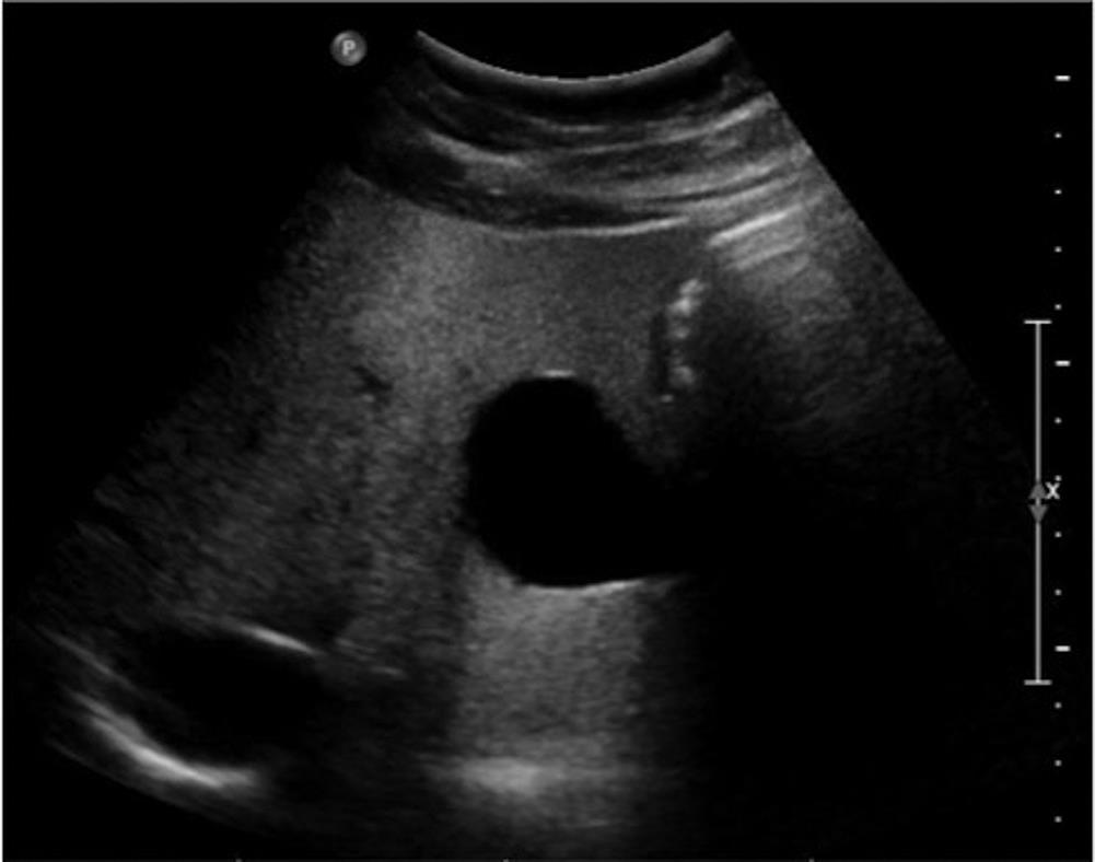 Grey scale US image demonstrates an anechoic lesion in the left hepatic lobe, which has increased through transmission consistent with a simple cyst.