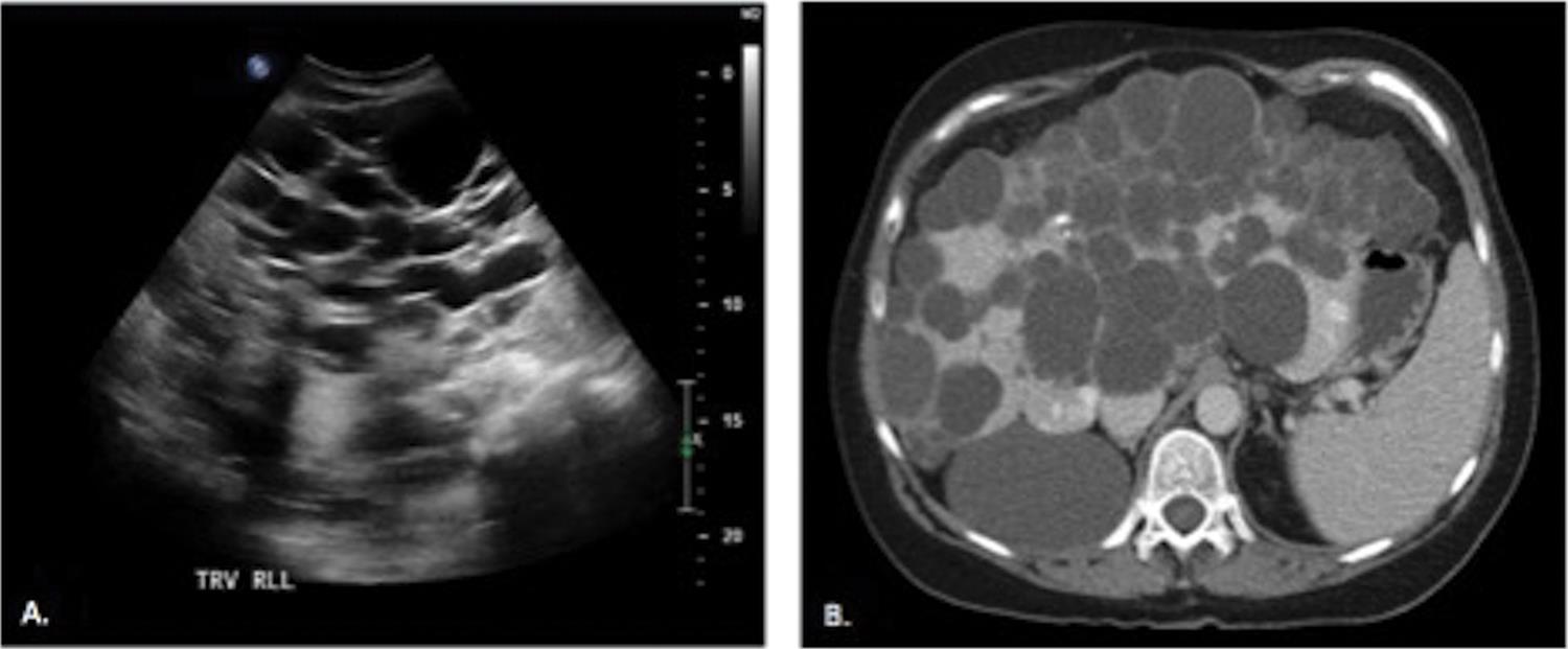 (A) US image demonstrates numerous anechoic lesions occupying the majority of the right hepatic lobe, consistent with numerous hepatic cysts. (B) Contrast-enhanced CT corroborating the US findings with numerous hypodensities occupying the majority of liver consistent with polycystic liver disease.