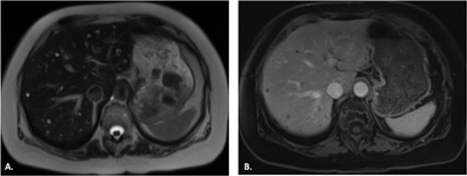 A. T2-weighted MRI image demonstrates numerous subcentimeter T2 hyperintense foci in the liver. B. Postcontrast T1-weighted image with fat saturation confirms the foci do not demonstrate enhancement, consistent with biliary hamartomas.