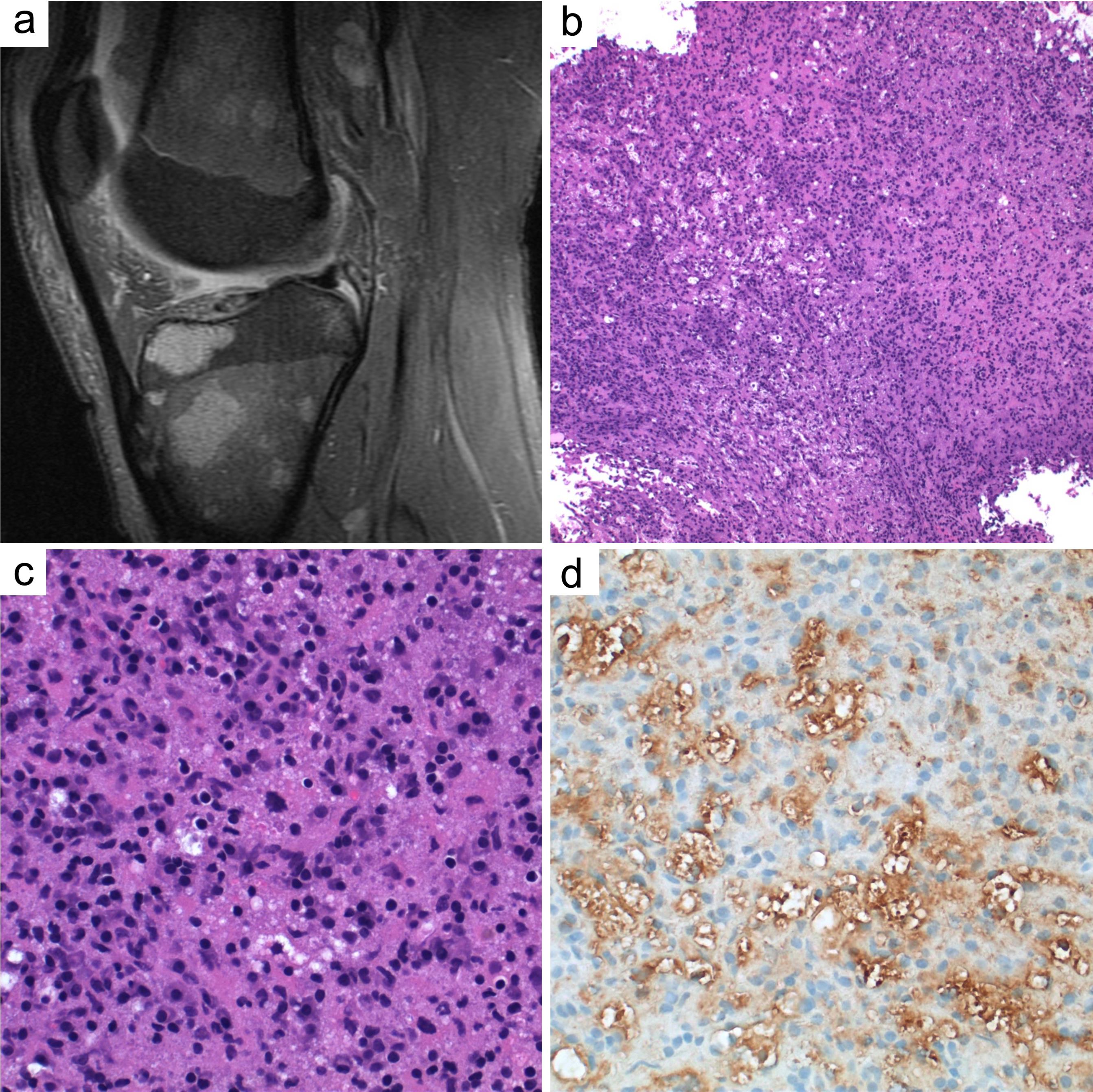 Example of Rosai-Dorfman-Destombes disease (RDD).