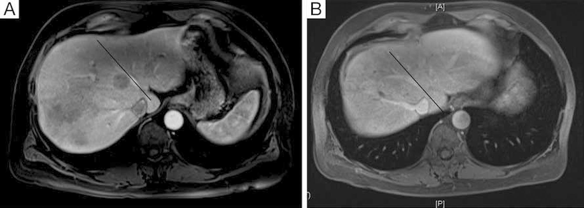 (A) Pre-portal vein embolization of right lobe of liver to induce hypertrophy of left lobe of liver. (B) Six weeks post-portal vein embolization of right lobe of liver to induce hypertrophy of left lobe of liver.