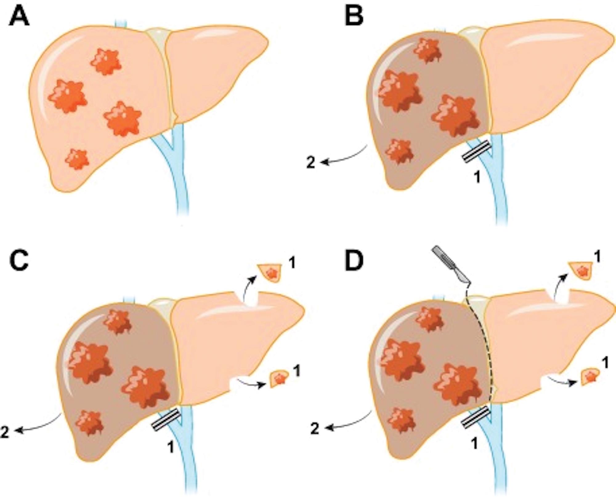 Visualization of pre- or perioperative interventions and their effect on liver remnant volume.